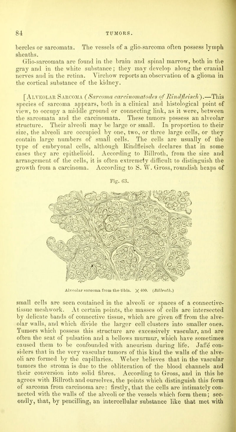 bercles or sarcomata. The vessels of a glio-sarcoma often possess lymph sheaths. Glio-sarcomata are found in the brain and spinal marrow, both in the gray and in the white substance; they may develop along the cranial nerves and in the retina. Virchow reports an observation of a glioma in the cortical substance of the kidney. [Alveolar Sarcoma (Sarcoma carcinomatodes of RindfleiscK).—This species of sarcoma appears, both in a clinical and histological point of view, to occupy a middle ground or connecting link, as it were, between the sarcomata and the carcinomata. These tumors possess an alveolar structure. Their alveoli may be large or small. In proportion to their size, the alveoli are occupied by one, two, or three large cells, or they contain large numbers of small cells. The cells are usually of the type of embryonal cells, although Rindfleisch declares that in some cases they are epithelioid. According to Billroth, from the size and arrangement of the cells, it is often extremely difficult to distinguish the growth from a carcinoma. According to S. W. Gross, roundish heaps of Fig. 63. Alveolar sarcoma from the tibia. X ^00. (Billroth.) small cells are seen contained in the alveoli or spaces of a connective- tissue meshwork. At certain points, the masses of cells are intersected by delicate bands of connective tissue, which are given off from the alve- olar walls, and which divide the larger cell clusters into smaller ones. Tumors which possess this structure are excessively vascular, and are often the seat of pulsation and a bellows murmur, which have sometimes caused them to be confounded with aneurism during life. Jaffa con- siders that in the very vascular tumors of this kind the walls of the alve- oli are formed by the capillaries. Weber believes that in the vascular tumors the stroma is due to the obliteration of the blood channels and their conversion into solid fibres. According to Gross, and in this he agrees with Billroth and ourselves, the points which distinguish this form of sarcoma from carcinoma are: firstly, that the cells are intimately com nected with the walls of the alveoli or the vessels which form them; sec- ondly, that, by pencilling, an intercellular substance like that met with