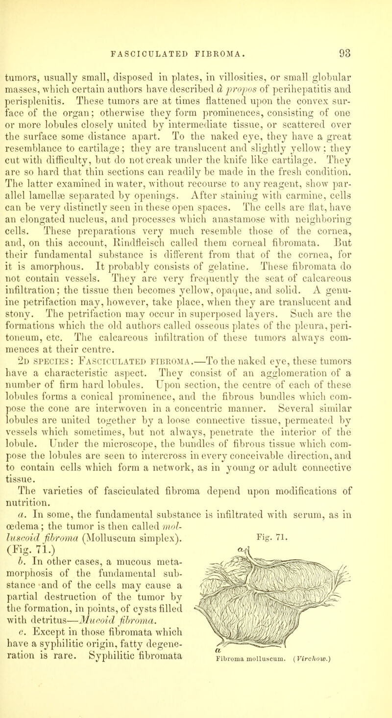 tumors, usually small, disposed in plates, in villosities, or small globular masses, which certain authors have described & propos of perihepatitis and perisplenitis. These tumors are at times flattened upon the convex sur- face of the organ; otherwise they form prominences, consisting of one or more lobules closely united by intermediate tissue, or scattered over the surface some distance apart. To the naked eye, they have a great resemblance to cartilage; they are translucent and slightly yellow: they cut with difficulty, but do not creak under the knife like cartilage. They are so hard that thin sections can readily be made in the fresh condition. The latter examined in water, without recourse to any reagent, show par- allel lamellae separated by openings. After staining with carmine, cells can be very distinctly seen in these open spaces. The cells are flat, have an elongated nucleus, and processes which anastamose with neighboring cells. These preparations very much resemble those of the cornea, and, on this account, Rindfleisch called them corneal fibromata. But their fundamental substance is different from that of the cornea, for it is amorphous. It probably consists of gelatine. These fibromata do not contain vessels. They are very frequently the seat of calcareous infiltration; the tissue then becomes yellow, opaque, and solid. A genu- ine petrifaction may, however, take place, when they are translucent and stony. The petrifaction may occur in superposed layers. Such are the formations which the old authors called osseous plates of the pleura, peri- toneum, etc. The calcareous infiltration of these tumors always com- mences at their centre. 2d species: Fasciculated fibroma.—To the naked eye, these tumors have a characteristic aspect. They consist of an agglomeration of a number of firm hard lobules. Upon section, the centre of each of these lobules forms a conical prominence, and the fibrous bundles which com- pose the cone are interwoven in a concentric manner. Several similar lobules are united together by a loose connective tissue, permeated by vessels which sometimes, but not always, penetrate the interior of the lobule. Under the microscope, the bundles of fibrous tissue which com- pose the lobules are seen to intercross in every conceivable direction, and to contain cells which form a network, as in young or adult connective tissue. The varieties of fasciculated fibroma depend upon modifications of nutrition. a. In some, the fundamental substance is infiltrated with serum, as in oedema; the tumor is then called mol- luscoid fibroma (Molluscum simplex). Fig. 71. (Fig. 71.) b. In other cases, a mucous meta- morphosis of the fundamental sub- stance and of the cells may cause a partial destruction of the tumor by the formation, in points, of cysts filled with detritus—Mucoid fibroma. c. Except in those fibromata wThich have a syphilitic origin, fatty degene- ration is rare. Syphilitic fibromata Ftoma molluscum. (Virchow.)