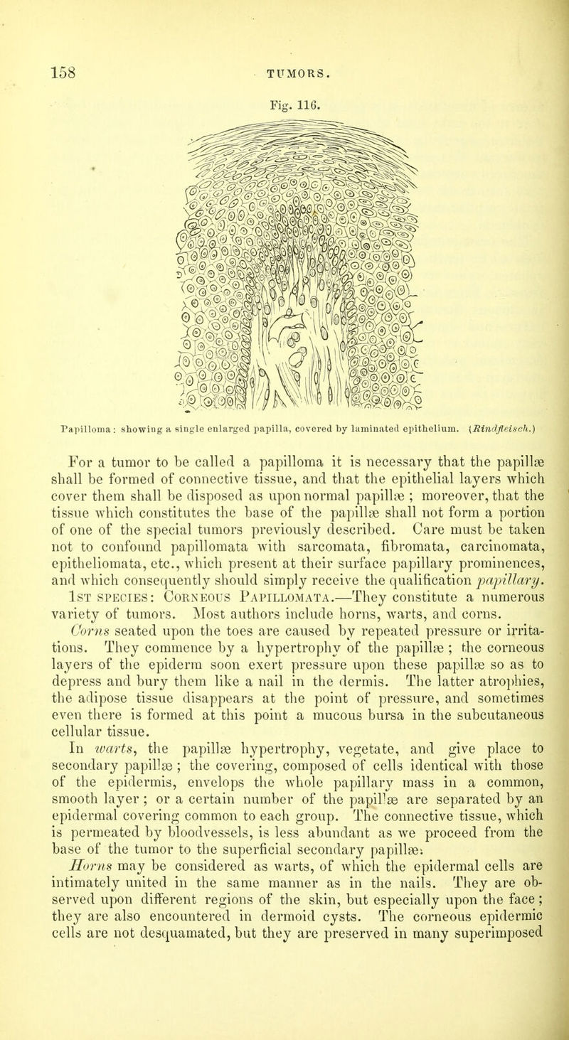 Fig. 116. Papilloma: showing a single enlarged papilla, covered by laminated epithelium. (Rindfleisch.) For a tumor to be called a papilloma it is necessary that the papillae shall be formed of connective tissue, and that the epithelial layers which cover them shall be disposed as upon normal papillae ; moreover, that the tissue which constitutes the base of the papillae shall not form a portion of one of the special tumors previously described. Care must be taken not to confound papillomata with sarcomata, fibromata, carcinomata, epitheliomata, etc., which present at their surface papillary prominences, and which consequently should simply receive the qualification papillary. 1st species: Corneous Papillomata.—They constitute a numerous variety of tumors. Most authors include horns, warts, and corns. Corns seated upon the toes are caused by repeated pressure or irrita- tions. They commence by a hypertrophy of the papillae ; the corneous layers of the epiderm soon exert pressure upon these papillae so as to depress and bury them like a nail in the dermis. The latter atrophies, the adipose tissue disappears at the point of pressure, and sometimes even there is formed at this point a mucous bursa in the subcutaneous cellular tissue. In warts, the papillae hypertrophy, vegetate, and give place to secondary papillae ; the covering, composed of cells identical with those of the epidermis, envelops the whole papillary mass in a common, smooth layer ; or a certain number of the papillae are separated by an epidermal covering common to each group. The connective tissue, which is permeated by bloodvessels, is less abundant as we proceed from the base of the tumor to the superficial secondary papillae: Horns may be considered as warts, of which the epidermal cells are intimately united in the same manner as in the nails. They are ob- served upon diiferent regions of the skin, but especially upon the face; they are also encountered in dermoid cysts. The corneous epidermic cells are not desquamated, but they are preserved in many superimposed