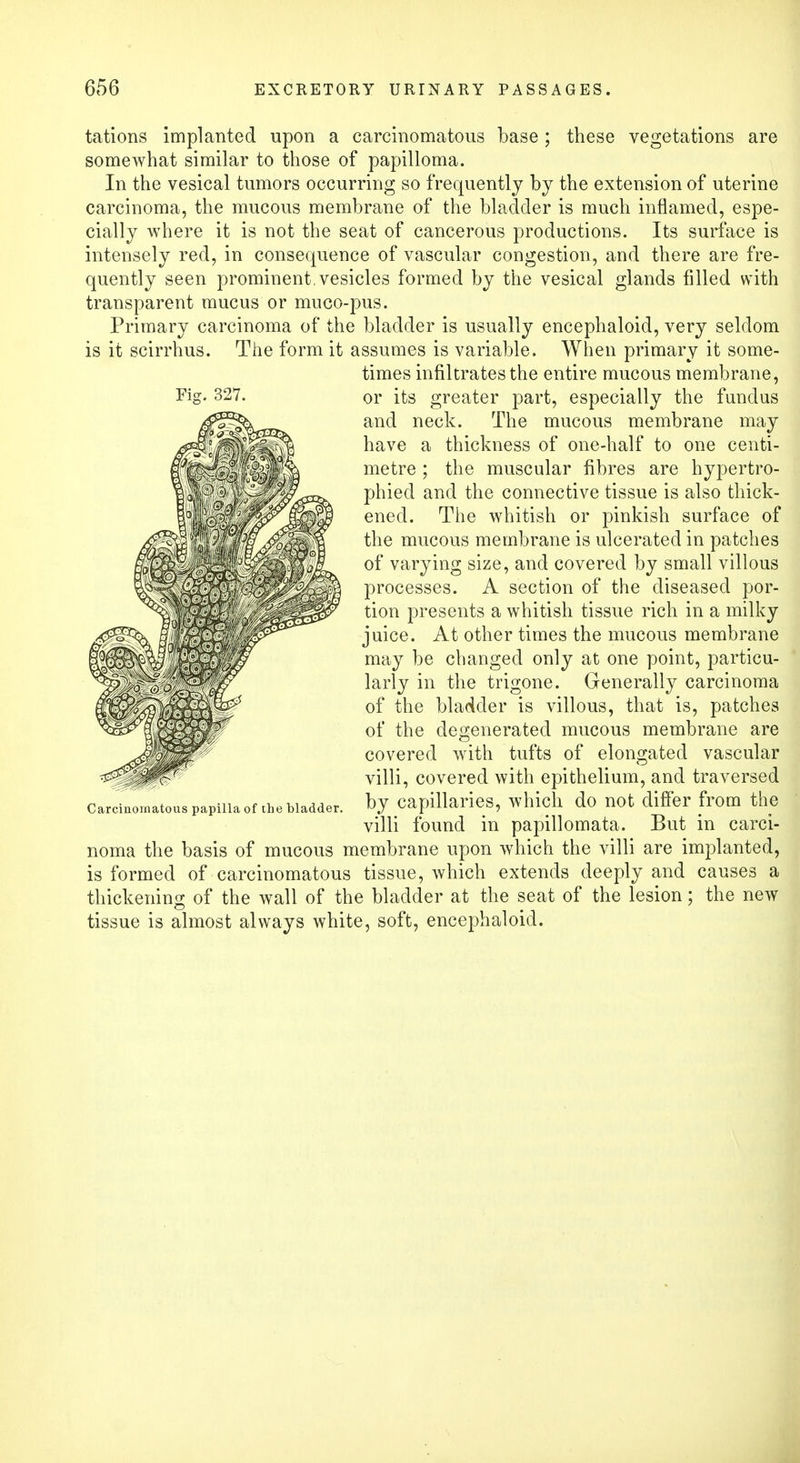 Fig. 327. tations implanted upon a carcinomatous base; these vegetations are somewhat similar to those of papilloma. In the vesical tumors occurring so frequently by the extension of uterine carcinoma, the mucous membrane of the bladder is much inflamed, espe- cially where it is not the seat of cancerous productions. Its surface is intensely red, in consequence of vascular congestion, and there are fre- quently seen prominent, vesicles formed by the vesical glands filled with transparent mucus or muco-pus. Primary carcinoma of the bladder is usually encephaloid, very seldom is it scirrhus. The form it assumes is variable. When primary it some- times infiltrates the entire mucous membrane, or its greater part, especially the fundus and neck. The mucous membrane may have a thickness of one-half to one centi- metre ; the muscular fibres are hypertro- phied and the connective tissue is also thick- ened. The whitish or pinkish surface of the mucous membrane is ulcerated in patches of varying size, and covered by small villous processes. A section of the diseased por- tion presents a whitish tissue rich in a milky juice. At other times the mucous membrane may be changed only at one point, particu- larly in the trigone. Generally carcinoma of the bladder is villous, that is, patches of the degenerated mucous membrane are covered with tufts of elongated vascular villi, covered with epithelium, and traversed by capillaries, which do not differ from the villi found in papillomata. But in carci- noma the basis of mucous membrane upon which the villi are implanted, is formed of carcinomatous tissue, which extends deeply and causes a thickening of the wall of the bladder at the seat of the lesion; the new tissue is almost always white, soft, encephaloid. Carcinomatous papilla of the bladder.