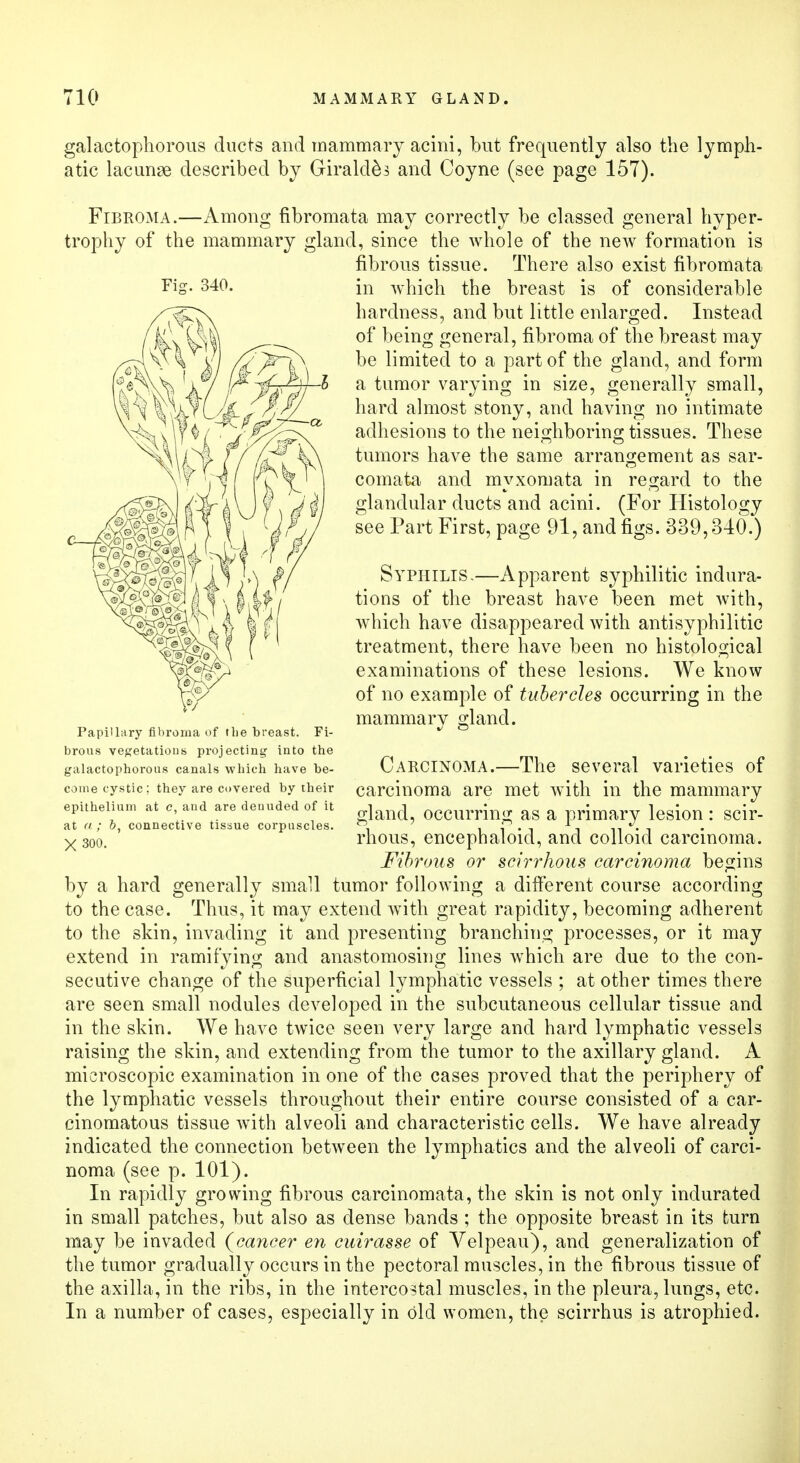 gaiactophorous ducts and mammary acini, but frequently also the lymph- atic lacunae described by Girald&s and Coyne (see page 157). Fibroma.—Among fibromata may correctly be classed general hyper- trophy of the mammary gland, since the whole of the new formation is fibrous tissue. There also exist fibromata in which the breast is of considerable hardness, and but little enlarged. Instead of being general, fibroma of the breast may be limited to a part of the gland, and form a tumor varying in size, generally small, hard almost stony, and having no intimate adhesions to the neighboring tissues. These tumors have the same arrangement as sar- comata and myxomata in regard to the glandular ducts and acini. (For Histology see Part First, page 91, and figs. 339,340.) Syphilis-—Apparent syphilitic indura- tions of the breast have been met with, which have disappeared with antisyphilitic treatment, there have been no histological examinations of these lesions. We know of no example of tubercles occurring in the mammary gland. brous vegetations projecting into the gaiactophorous canals which have be- Carcinoma.—The several varieties of come cystic; they are covered by their carcinoma are met with in the mammary epithelium at c and are denuded of it QCCurri' ag ft primary lesion I SCir- at a; b, connective tissue corpuscles. °. i i • i n • i x 300! rhous, encephaloid, and colloid carcinoma. Fibrous or scirrhous carcinoma begins by a hard generally small tumor following a different course according to the case. Thus, it may extend with great rapidity, becoming adherent to the skin, invading it and presenting branching processes, or it may extend in ramifying and anastomosing lines which are due to the con- secutive change of the superficial lymphatic vessels ; at other times there are seen small nodules developed in the subcutaneous cellular tissue and in the skin. We have twice seen very large and hard lymphatic vessels raising the skin, and extending from the tumor to the axillary gland. A microscopic examination in one of the cases proved that the periphery of the lymphatic vessels throughout their entire course consisted of a car- cinomatous tissue with alveoli and characteristic cells. We have already indicated the connection between the lymphatics and the alveoli of carci- noma (see p. 101). In rapidly growing fibrous carcinomata, the skin is not only indurated in small patches, but also as dense bands ; the opposite breast in its turn may be invaded {cancer en cuirasse of Velpeau), and generalization of the tumor gradually occurs in the pectoral muscles, in the fibrous tissue of the axilla, in the ribs, in the intercostal muscles, in the pleura, lungs, etc. In a number of cases, especially in old women, the scirrhus is atrophied. Fig. 340. Papillary fibroma of the breast. Fi-