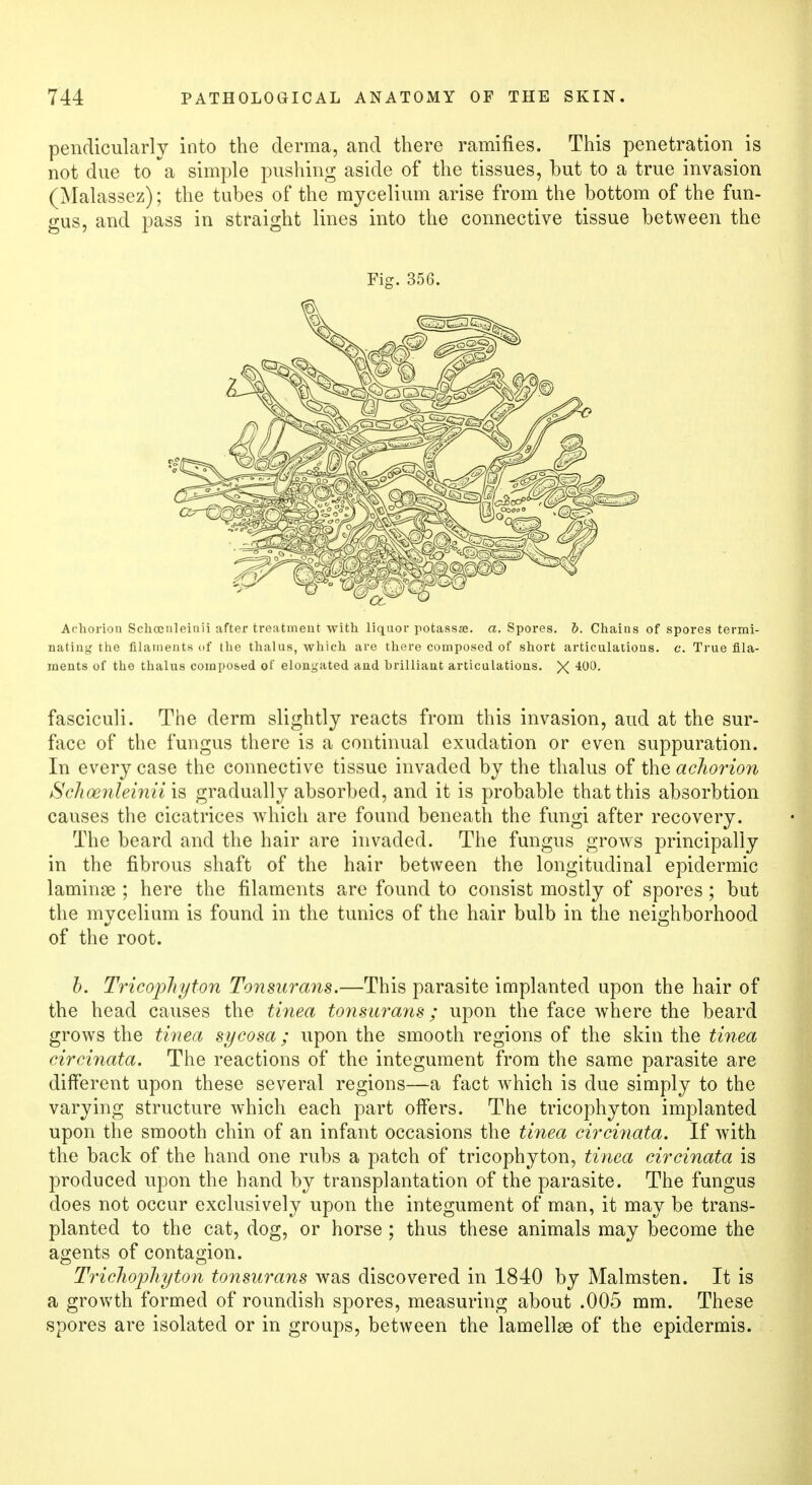 pendicularly into the derma, and there ramifies. This penetration is not due to a simple pushing aside of the tissues, but to a true invasion (Malassez); the tubes of the mycelium arise from the bottom of the fun- gus, and pass in straight lines into the connective tissue between the Fig. 356. Achorion Schoenleinii after treatment with liquor potassae. a. Spores, b. Chains of spores termi- nating the filaments of the thalus, Avhich are there composed of short articulations, c. True fila- ments of the thalus composed of elongated and brilliant articulations. X fasciculi. The derm slightly reacts from this invasion, aud at the sur- face of the fungus there is a continual exudation or even suppuration. In every case the connective tissue invaded by the thalus of the achorion Schoenleinii is gradually absorbed, and it is probable that this absorbtion causes the cicatrices which are found beneath the fungi after recovery. The beard and the hair are invaded. The fungus grows principally in the fibrous shaft of the hair between the longitudinal epidermic laminae ; here the filaments are found to consist mostly of spores; but the mycelium is found in the tunics of the hair bulb in the neighborhood of the root. b. Tricophyton Tonsurans.—This parasite implanted upon the hair of the head causes the tinea tonsurans; upon the face where the beard grows the tinea sycosa; upon the smooth regions of the skin the tinea circinata. The reactions of the integument from the same parasite are different upon these several regions—a fact which is due simply to the varying structure which each part offers. The tricophyton implanted upon the smooth chin of an infant occasions the tinea circinata. If with the back of the hand one rubs a patch of tricophyton, tinea circinata is produced upon the hand by transplantation of the parasite. The fungus does not occur exclusively upon the integument of man, it may be trans- planted to the cat, dog, or horse ; thus these animals may become the agents of contagion. Trichophyton tonsurans was discovered in 1840 by Malmsten. It is a growth formed of roundish spores, measuring about .005 mm. These spores are isolated or in groups, between the lamellae of the epidermis.