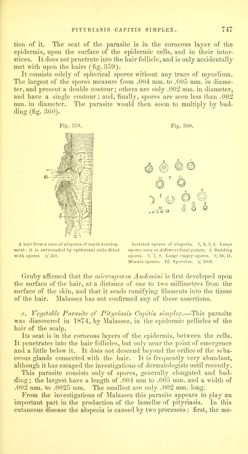 tion of it. The seat of the parasite is in the corneous layer of the epidermis, upon the surface of the epidermic cells, and in their inter- stices. It does not penetrate into the hair follicle, and is only accidentally met with upon the hairs (fig. 359). It consists solely of spherical spores without any trace of mycelium. The largest of the spores measure from .004 mm. to .005 mm. in diame- ter, and present a double contour; others are only .002 mm. in diameter, and have a single contour; and, finally, spores are seen less than .002 mm. in diameter. The parasite would then seem to multiply by bud- ding (fig. 300). Fig. 359. Fig. 360. liiilHHii A hair from a case of alopecia of rapid develop- Isolated spores of alopecia. 1,2,3,4. Large ment: it is surrounded by epidermal cells filled spores seen at different focal points. 5. Budding with spores X 250. spores. 6, 7, 8. Large empty spores. 9, 10, 11. Minute spores. 12. Sporules. X 1000. Gruby affirmed that the microsporon Audouini is first developed upon the surface of the hair, at a distance of one to two millimetres from the surface of the skin, and that it sends ramifying filaments into the tissue of the hair. Malassez has not confirmed any of these assertions. e. Vegetable Parasite of Pityriasis Capitis simplex.—This parasite was discovered in 1874, by Malassez, in the epidermic pellicles of the hair of the scalp. Its seat is in the corneous layers of the epidermis, between the cells. It penetrates into the hair follicles, but only near the point of emergence and a little below it. It does not descend beyond the orifice of the seba- ceous glands connected with the hair. It is frequently very abundant, although it has escaped the investigations of dermatologists until recently. This parasite consists only of spores, generally elongated and bud- ding ; the largest have a length of .004 mm to .005 mm. and a width of .002 mm. to .0025 mm. The smallest are only .002 mm. long. From the investigations of Malassez this parasite appears to play an important part in the production of the lamellae of pityriasis. In this cutaneous disease the alopecia is caused by two processes : first, the me-