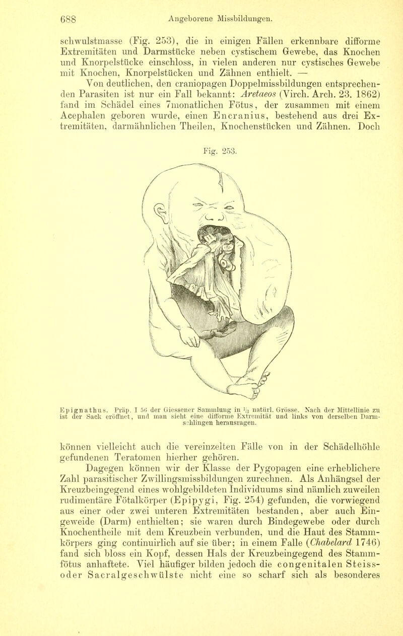 scliwulstmasse (Fig. 253), die in einigen Fällen erkennbare difForme Extremitäten und Darmstücke neben cystiscbem Gewebe, das Knochen und Knorpelstücke einschloss, in vielen anderen nur cystisclies Gewebe mit Knochen, Knorpelstücken und Zähnen enthielt. — Von deutlichen, den craniopagen Doppelmissbildungen entsprechen- den Parasiten ist nur ein Fall bekannt: Aretaeos (Virch. Arch. 23. 1862) fand im Schädel eines 7monatlichen Fötus, der zusammen mit einem Acephalen geboren wurde, einen Encranius, bestehend aus drei Ex- tremitäten, darmähnlichen Theilen, Knochenstücken und Zähnen. Doch Fig. 253. Epignathus. Präp. I 5(3 der Giessener Sammlung in 1/3 natüii. Grösse. Nach der Mittellinie zu ist der Sack eröffnet, und man sieht eine diff'orme Extremität und links von derselben Darm- sclilingen herausragen. können vielleicht auch die vereinzelten Fälle von in der Schädelhöhle gefundenen Teratomen hierher gehören. Dagegen können wir der Klasse der Pjgopagen eine erheblichere Zahl parasitischer Zwillingsmissbildungen zurechnen. Als Anhängsel der Kreuzbeingegend eines wohlgebildeten Individuums sind nämlich zuweilen rudimentäre Fötalkörper (Epipygi, Fig. 254) gefunden, die vorwiegend aus einer oder zwei unteren Extremitäten bestanden, aber auch Ein- geweide (Darm) enthielten; sie waren durch Bindegewebe oder durch Knochentheile mit dem Kreuzbein verbunden, und die Haut des Stamm- körpers ging continuirlich auf sie über; in einem Falle (Chabelard 1746) fand sich bloss ein Kopf, dessen Hals der Kreuzbeingegend des Stamm- fötus anhaftete. Viel häufiger bilden jedoch die congenitalen Steiss- oder Sacralgeschwülste nicht eine so scharf sich als besonderes