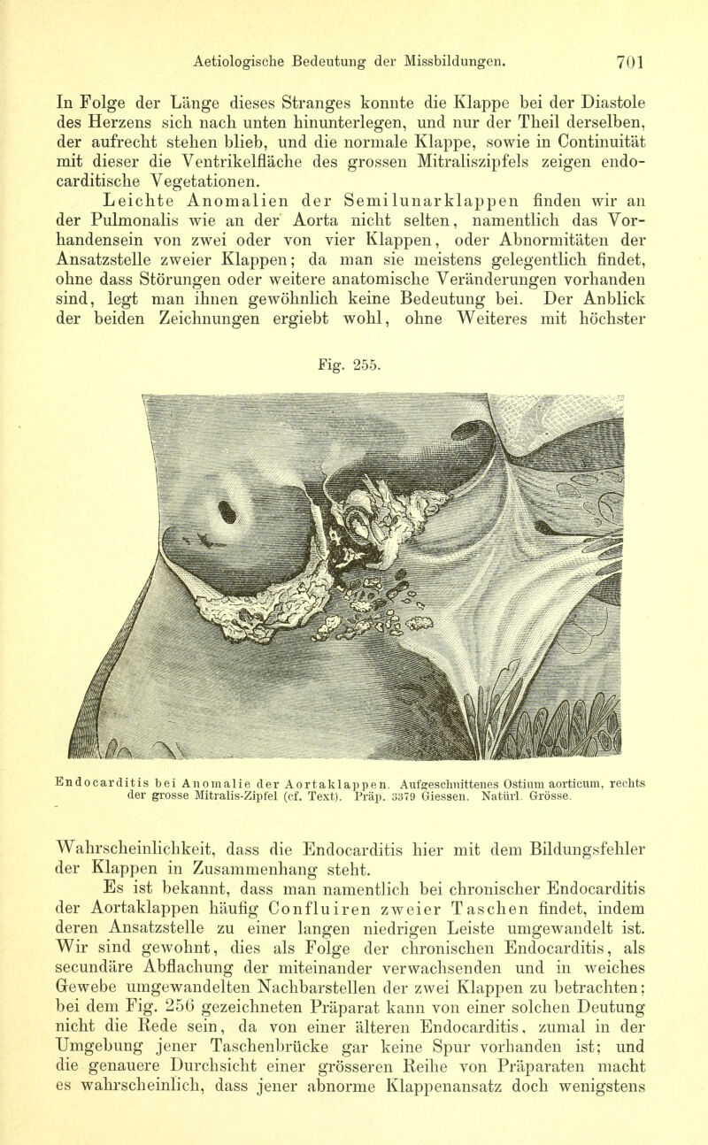 In Folge der Länge dieses Stranges konnte die Klappe bei der Diastole des Herzens sich nach unten hinunterlegen, und nur der Theil derselben, der aufrecht stehen blieb, und die normale Klappe, sowie in Continuität mit dieser die Ventrikelfläche des grossen Mitraliszipfels zeigen endo- carditische Vegetationen. Leichte Anomalien der Semilunarklappen finden wir an der Pulmonalis wie an der Aorta nicht selten, namentlich das Vor- handensein von zwei oder von vier Klappen, oder Abnormitäten der Ansatzstelle zweier Klappen; da man sie meistens gelegentlich findet, ohne dass Störungen oder weitere anatomische Veränderungen vorhanden sind, legt man ihnen gewöhnlich keine Bedeutung bei. Der Anblick der beiden Zeichnungen ergiebt wohl, ohne Weiteres mit höchster Fig. 255. Endocarditis bei Anomalie der Aortaklappen. Aufe:eschnittenes Ostium aorticum, rechts der grosse Mitralis-Zipfel (cf. Text). Präp. 3379 Giessen. Natürl. Grösse. Wahrscheinlichkeit, dass die Endocarditis hier mit dem Bildungsfehler der Klappen in Zusammenhang steht. Es ist bekannt, dass man namentlich bei chronischer Endocarditis der Aortaklappen häufig Confluiren zweier Taschen findet, indem deren Ansatzstelle zu einer langen niedrigen Leiste umgewandelt ist. Wir sind gewohnt, dies als Folge der chronischen Endocarditis, als secundäre Abflachung der miteinander verwachsenden und in weiches Grewebe umgewandelten Nachbarstellen der zwei Klappen zu betrachten; bei dem Fig. 256 gezeichneten Präparat kann von einer solchen Deutung nicht die Rede sein, da von einer älteren Endocarditis, zumal in der Umgebung jener Taschenbrücke gar keine Spur vorhanden ist; und die genauere Durchsicht einer grösseren Reihe von Präparaten macht es wahrscheinlich, dass jener abnorme Klappenansatz doch wenigstens