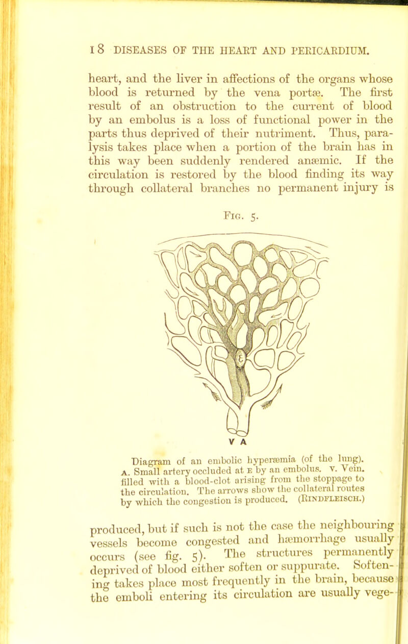 heart, and the liver in affections of the organs whose blood is returned by the vena porta?. The first result of an obstruction to the current of blood by an embolus is a loss of functional power in the parts thus deprived of their nutriment. Thus, para- lysis takes place when a portion of the brain has in this way been suddenly rendered anaemic. If the circulation is restored by the blood finding its way through collateral branches no permanent injury is Fig. 5. V A Diagram of an embolic hyperemia (of tbo lung). A Small artery occluded at E by an embolus, v. Vein, filled with a blood-clot, arising from the stoppage to the circulation. The arrows show the collateral routes by which the congestion is produced. (Rindfleisch.) produced, but if such is not the case the neighbouring vessels become congested and haemorrhage usually occurs (see fig. 5). The structures permanently deprived of blood either soften or suppurate. Soften- ing takes place most frequently in the brain, because the emboli entering its circulation are usually vege-