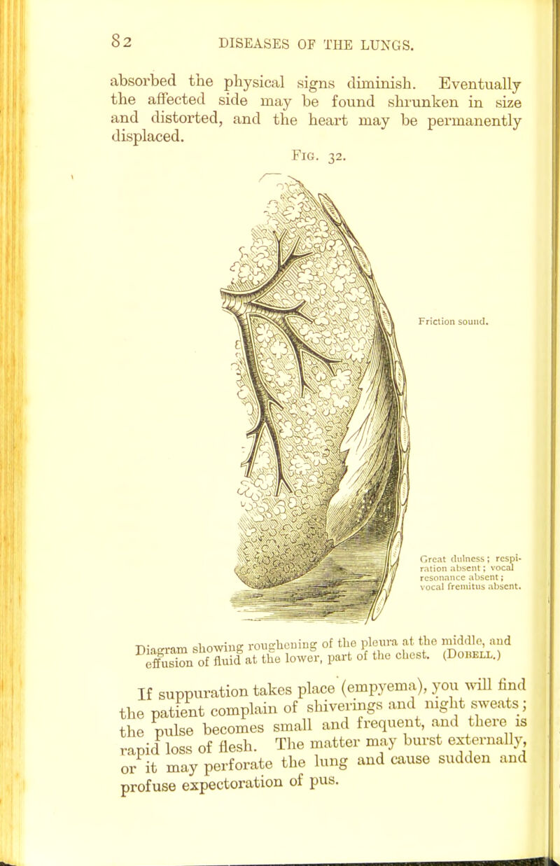 absorbed the physical signs diminish. Eventually the affected side may be found shrunken in size and distorted, and the heart may be permanently displaced. Fig. 32. Friction sound. Great chilness; respi- ration absent; vocal resonance absent; vocal fremitus absent. -r,- i r.-^-ntr rmio-hemnsr of the pleura at the middle, aud DS.Sd&tlS part o\ the chest. (Dobbll.) If suppuration takes place'(empyema), you will find the patient complain of sMverings and night sweats; the pulse becomes small and frequent, and there is rapid loss of flesh. The matter may burst externally, or it may perforate the lung and cause sudden and profuse expectoration of pus.