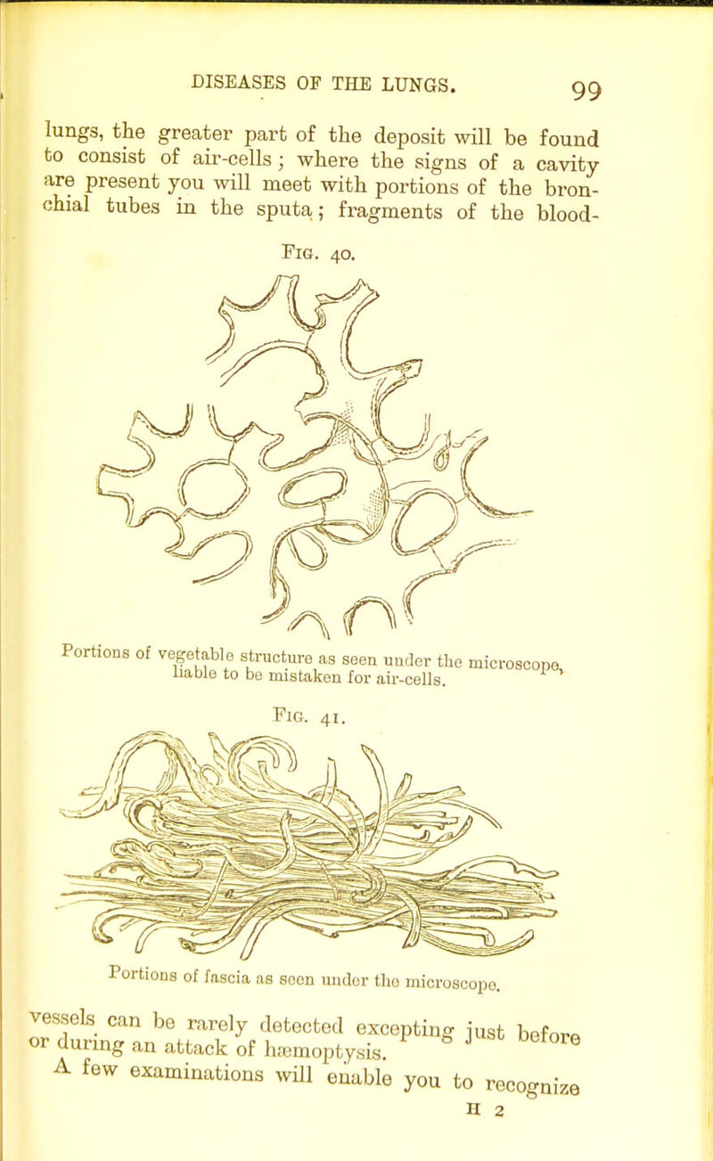 lungs, the greater part of the deposit will be found to consist of air-cells; where the signs of a cavity are present you will meet with portions of the bron- chial tubes in the sputa; fragments of the blood- Fig. 40. Portions of vegetable structure as seen under the microscope, liable to be mistaken for air-cells. Fig. 41. Portions of fascia as soon undor tho microscope. vessels can be rarely detected excepting just before or during an attack of hemoptysis. 6 A few examinations will enable you to recognize H 2