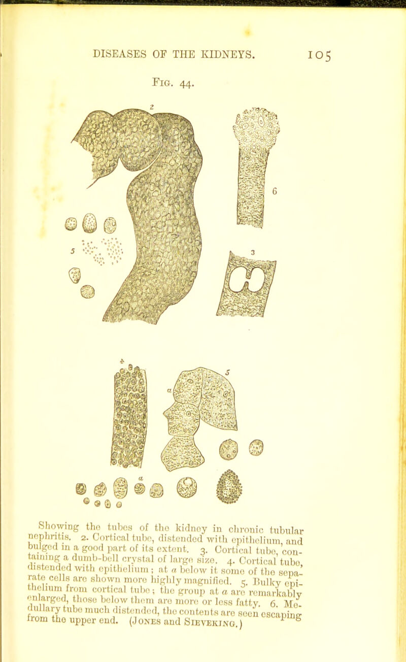 Fig. 44. Showing the tubes of the kidney in chronic tubular nephritis. 2. Cortical tube, distended with epithelium and bulged m a good part of its extent. 3. Cortical tube con- taining a dumb-bell crystal of large size. 4. Cortical tube distended with epithelium; at ». below it, son,,. 0f the Beoa' rate cells arc shown more highly magnified, e. Jdilkv ooi thehumfrom cortical tube; the group at a are remarkably enlarged, those below them arc mor • less Fattv 6 M,> dullary tube much distended, the contents are seen escaping from the upper end. Jones and Sibvekjng ) sullJm&