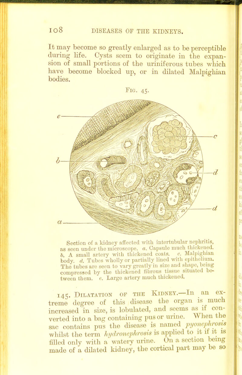 io8 It may become so greatly enlarged as to be perceptible during life. Cysts seem to originate in tbe expan- sion of small portions of the uriniferous tubes which have become blocked up, or in dilated Malpighian bodies. Fig. 45. Section of a kidney affected with mtertnbular nephritis, as seen under the microscope, a. Capsule much thickened. b. A small artery with thickened coats, c. Malpighian body. d. Tubes wholly or partially lined with epithelium. The tubes are seen to vary greatly in size and shape, being compressed by the thickened fibrous tissue situated be- tween them. e. Large artery much thickened. 145. Dilatation of the Kidney—In an ex- treme degree of this disease the organ is much increased in size, is lobulated, and seems as if con- verted into a bag containing pus or urine. V\ hen the sac contains pus the disease is named pyonephrosis whilst the term hydronephrosis is applied to it if it is filled only with a watery urine. On a section being made of a dilated kidney, the cortical part may be so