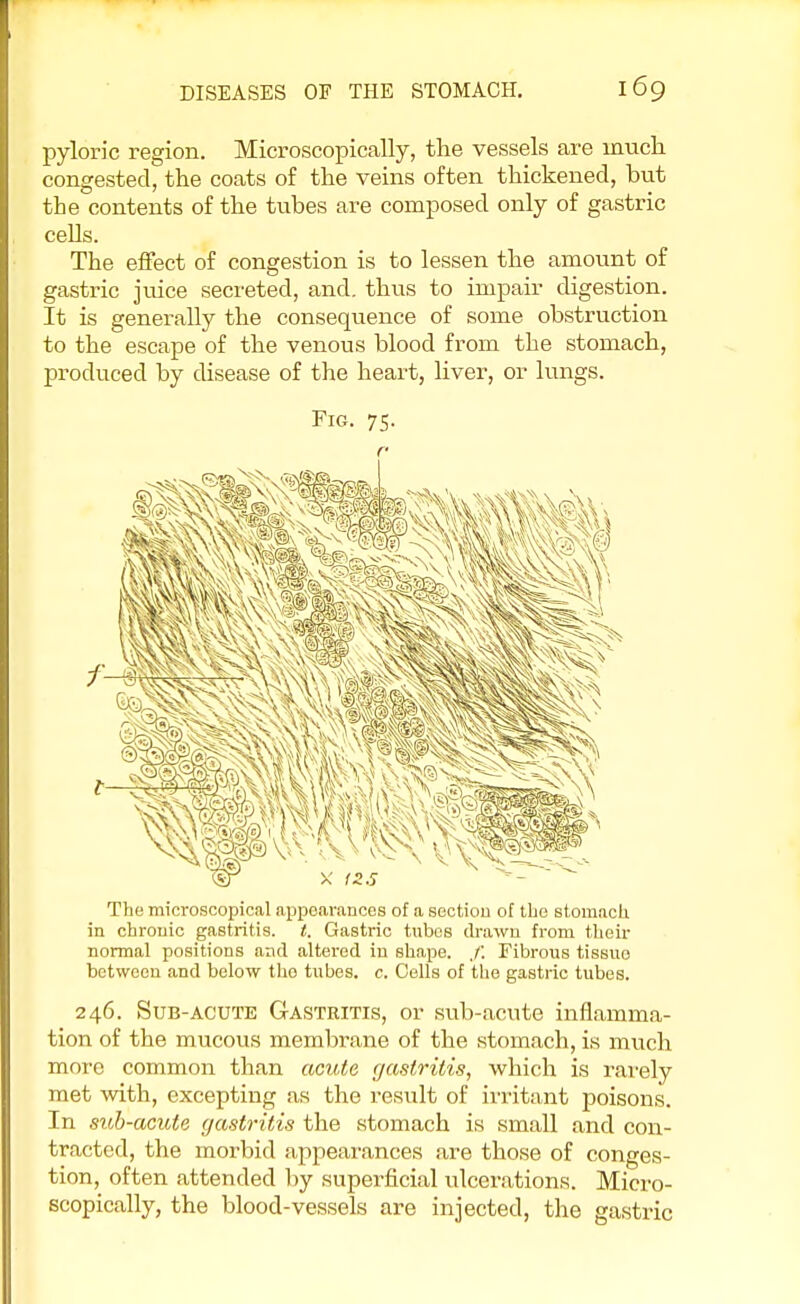 pyloric region. Microscopically, the vessels are much congested, the coats of the veins often thickened, but the contents of the tubes are composed only of gastric cells. The effect of congestion is to lessen the amount of gastric juice secreted, and. thus to impair digestion. It is generally the consequence of some obstruction to the escape of the venous blood from the stomach, produced by disease of the heart, liver, or lungs. Fig. 75. r The microscopical appearances of a section of the stomach in chronic gastritis, t. Gastric tubes drawn from their normal positions and altered in shape. ,/'. Fibrous tissue between and below tho tubes, c. Cells of the gastric tubes. 246. Sub-acute Gastritis, or sub-acute inflamma- tion of the mucous membrane of the stomach, is much more common than acute gastritis, which is rarely met with, excepting as the result of irritant poisons. In sub-acute gastritis the stomach is small and con- tracted, the morbid appearances .are those of conges- tion, often attended by superficial ulcerations. Micro- scopically, the blood-vessels are injected, the gastric