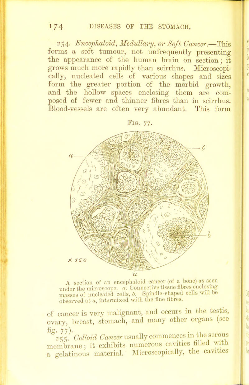 254. EncepJialoid, Medullary, or Soft Cancer.—This forms a soft tumour, not unfrequently presenting the appearance of the human brain on section; it grows much more rapidly than scirrhus. Microscopi- cally, nucleated cells of various shapes and sizes form the greater portion of the morbid growth, and the hollow sjDaces enclosing them are com- posed of fewer and thinner fibres than in scirrhus. Blood-vessels are often very abundant. This form Fig. 77. A section of au encephaloid cancer (of a bono) as seen under the microscope, a. < ionnective tissue fibres enclosing masses of nucleated cells, b. Spindle-shaped cells Will be observed at a, intermixed with the line fibres. of cancer is very malignant, and occurs in the testis, ovary, breast, stomach, and many other organs (see tig. 77). 255. Colloid Cancer usually commences in the serous membrane; it exhibits numerous cavities filled with a. gelatinous material. Microscopically, the cavities