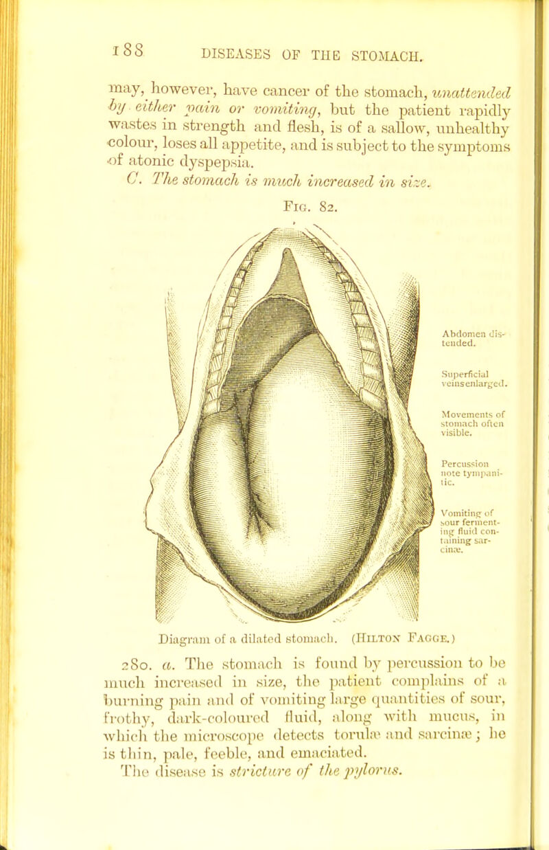 may, however, have cancer of the stomach, unattended by either vain or vomiting, but the patient rapidly wastes in strength and flesh, is of a sallow, unhealthy colour, loses all appetite, and is subject to the symptoms of atonic dyspepsia. C. The stomach is much increased in size. Fig. 82. Diagram of a dilated stomach. (Hilton Fagge.) 280. a. The stomach is found by percussion to be much increased in size, the patient complains of a burning pain and of vomiting large quantities of sour, frothy, dark-coloured fluid, along with mucus, in which the microscope detects toruhe and sarcinsej he is thin, pale, feeble, and emaciated. The disease is stricture of the pylorus.