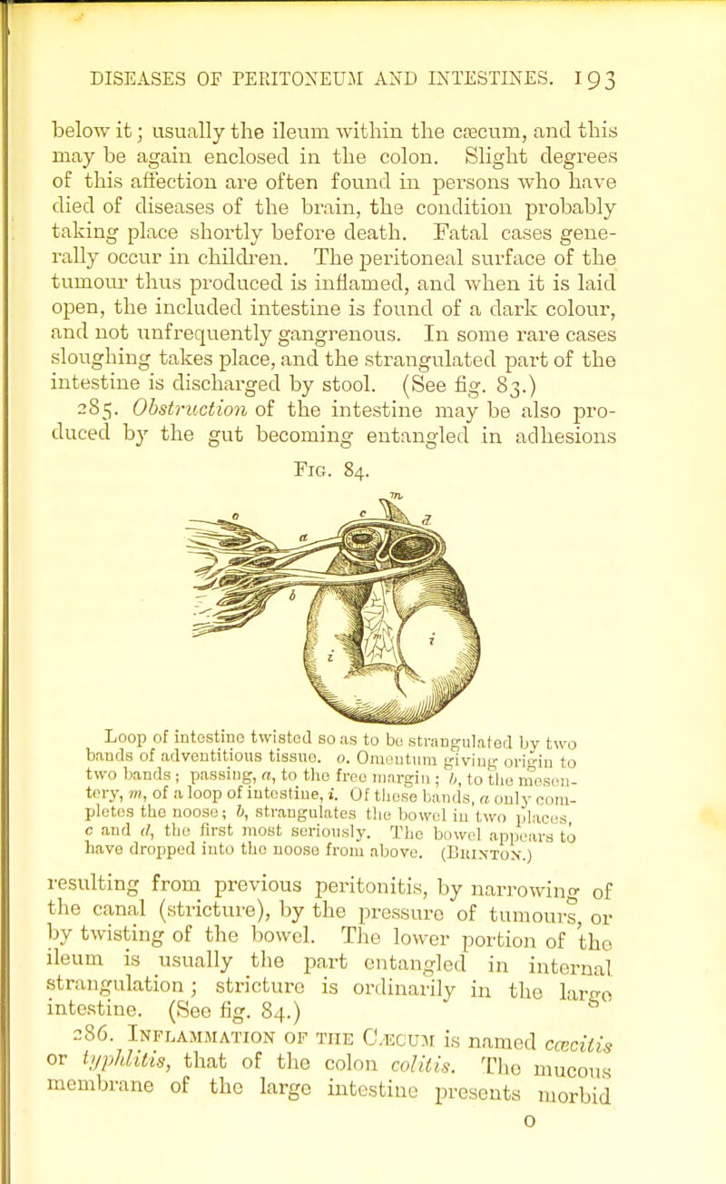 below it; usually the ileum within the CEecum, and this may be again enclosed in the colon. Slight degrees of this affection are often found in persons who have died of diseases of the brain, the condition probably taking place shortly before death. Fatal cases gene- rally occur in children. The peritoneal surface of the tumour thus produced is inflamed, and when it is laid open, the included intestine is found of a dark colour, and not unfrequently gangrenous. In some rare cases sloughing takes place, and the strangulated part of the intestine is discharged by stool. (See fig. 83.) 285. Obstruction of the intestine may be also pro- duced by the gut becoming entangled in adhesions Tig. 84. Loop of intcstino twisted so as to be strangulated by two bauds of adventitious tissue 0. Omentum giving- origin to two bands ; passing, a, to the free margin ; b, to the mesen- tery, m, of a loop of intestine, i. Of these bands, a only 01 im- pletes the noose; 6, strangulates the bowel in two places c and d, the first most seriously. The bowel appears to have dropped into the noose from above. (Biunton.) resulting from previous peritonitis, by narrowino- of the canal (stricture), by the pressure of tumours, or by twisting of the bowel. The lower portion of the ileum is usually the part entangled in internal strangulation; stricture is ordinarily in the largo intestine. (See fig. 84.) 2S6. Inflammation of the Cecum is named cceoitis or typhlitis, that of the colon colitis. The mucous membrane of the largo intestine presents morbid