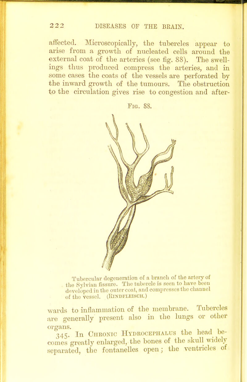 affected. Mict-oscopically, the tubercles appear to arise from a growth of nucleated cells around the external coat of the arteries (see fig. 88). The swell- ings thus produced compress the arteries, and in some cases the coats of the vessels are perforated by the inward growth of the tumours. The obstruction to the circulation sdves rise to congestion and after- Fig. 88. Tubercular degeneration of a branch of the artery of the Sylvian fissure. The tubercle is seen to have been developed in the outer coat, and compresses the channel Of the vessel. (KlNDFLEISCH.) wards to inflammation of the membrane. Tubercles are generally present also in the lungs or other organs. 345. In Chronic Hydrocephalus the head be- comes greatly enlarged, the bones of the skull widely separated, the fontanelles open; the ventricles of