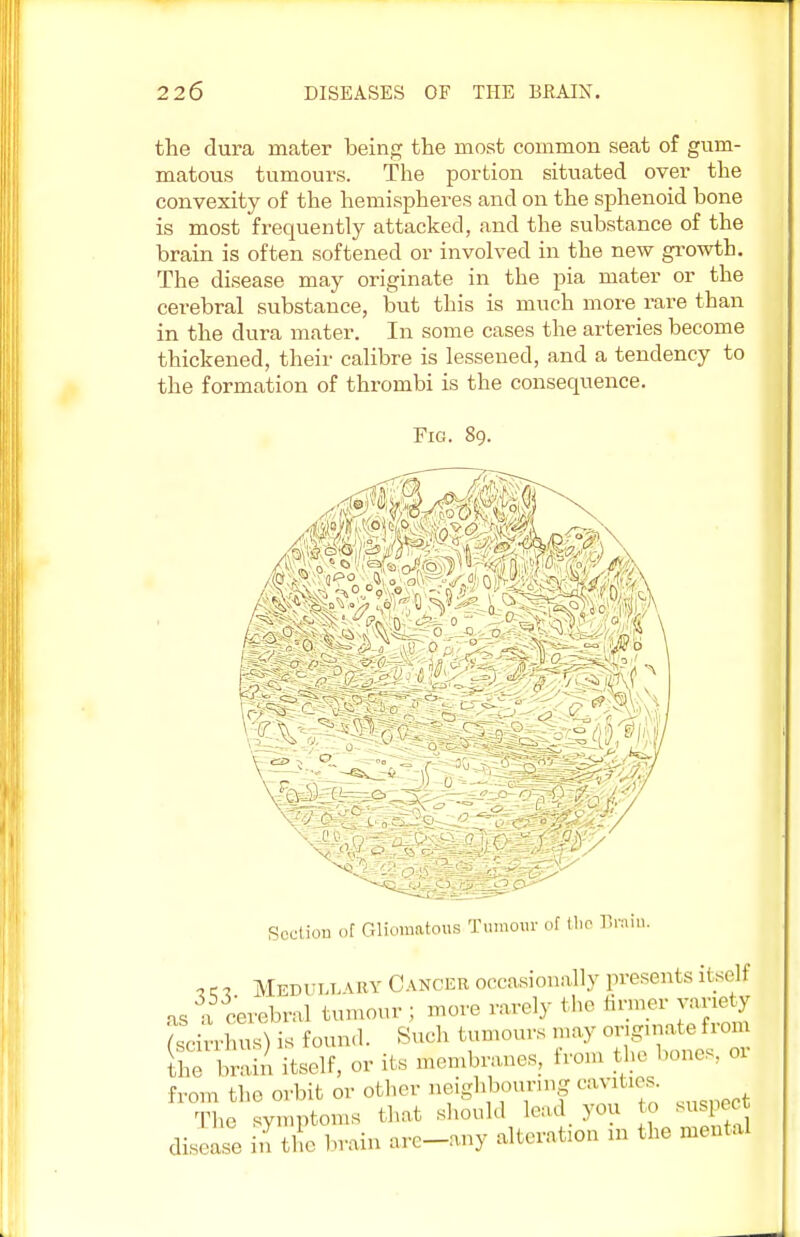 the dura mater being the most common seat of gum- matous tumours. The portion situated over the convexity of the hemispheres and on the sphenoid bone is most frequently attacked, and the substance of the brain is often softened or involved in the new growth. The disease may originate in the pia mater or the cerebral substance, but this is much more rare than in the dura mater. In some cases the arteries become thickened, their calibre is lessened, and a tendency to the formation of thrombi is the consequence. Fig. 89. |11 ills --0 j Section of Gliomatous Tumour of the Brain. 7 e 1 Medull vry Cancer occasionally presents itself •us a cerebral tumour ; more rarely the tinner variety . is found. Such tumours may originate from LI Lin itself, or its membranes, from the bones, or from the orbit or other neighbouring cavities. The symptoms that should lead you to suspect disease in tl brain are-any alteration m the mental