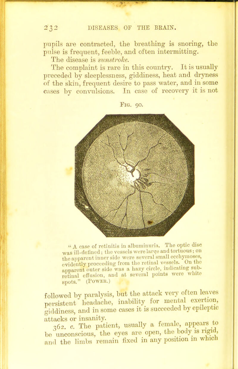 pupils are contracted, the breathing is snoring, the pulse is frequent, feeble, and often intermitting. The disease is sunstroke. The complaint is rare in this country. It is usually- preceded by sleeplessness, giddiness, heat and dryness of the skin, frequent desire to pass water, and in some cases by convulsions. In case of recovery it is not Fig. 90.  A case of retinitis in albuminuria. The optic disc ■was ill-defined ; the vessels were lar<*e and tortuous; on the apparent inner side were several small ecchymoses, eviden%prooeeding from the retinal vessels. On the apparent outer side was a hazy circle, indicating sub- retinal effusion, and at several points were white spots. (POWEH.) followed by paralysis, but the attack very often leaves persistent headache, inability for mental exertion, giddiness, and in some cases it is succeeded by epileptic attacks or insanity. •262 c The patient, usually a female, appears to bo'unconscious, the eyes are open, the body is rigid, and the limbs remain iixed in any position in winch