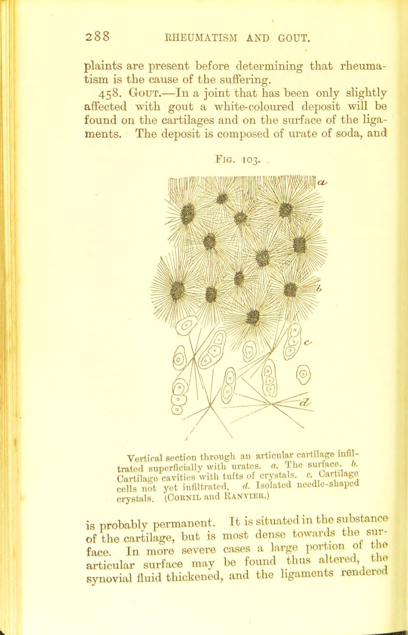 plaints are present before determining that rheuma- tism is the cause of the suffering. 458. Gout.—In a joint that has been only slightly- affected with gout a white-coloured deposit will be found on the cartilages and on the surface of the liga- ments. The deposit is composed of urate of soda, and Fig. 103. Vertical section through an articular cartilage infil- trated superficially with urates, a. The surface. 6. Cartilage cavities with tufts of crystals, e. Cartilage cells not yet infiltrated, d. Isolated needle-shaped crystals. (Cornit. and Hanvier.) is probably permanent. It is situated in the substance of the cartilage, but is most dense towards the sur- face. In more severe cases a large portion ot the articular surface may be found thus altered the synovial fluid thickened, and the ligaments rendered