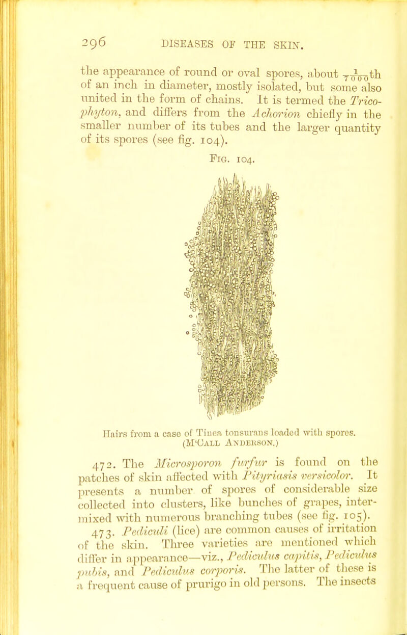 the appearance of round or oval spores, about ^m th of an inch in diameter, mostly isolated, but some also united in the form of chains. It is termed the Trico- 2)hyton. and differs from the Achorion chiefly in the smaller number of its tubes and the larger quantity of its spores (see fig. 104). Fig. 104. Hairs from a cases oF Tinea tonsurans loaded with spores. (M'Uall Anderson.) 472. The Microsporon furfur is found on the patches of skin affected with Pityriasis versicolor. It presents a number of spores of considerable size collected into clusters, like bunches of grapes, inter- mixed with numerous brandling tubes (see fig. 105). 473. Pediouli (lice) are common causes of irritation of tile skin. Three varieties are mentioned which differ in appearance—viz., Pedioulus capitis, Pedicvlus pubis, and Pediculus corporis. The latter of these is a frequent cause of prurigo in old persons. The insects