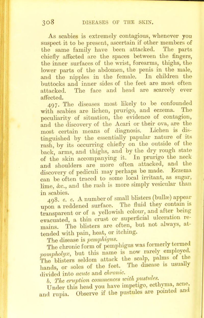 As scabies is extremely contagious, whenever you suspect it to be present, ascertain if other members of the same family have been attacked. The parts chiefly affected are the spaces between the fingers, the inner surfaces of the wrist, forearms, thighs, the lower parts of the abdomen, the penis in the male, and the nipples in the female. In children the buttocks and inner sides of the feet are most often attacked. The face and head are scarcely ever affected. 497. The diseases most likely to be confounded with scabies are lichen, prurigo, and eczema. The peculiarity of situation, the evidence of contagion, and the discovery of the Acari or their ova, are the most certain means of diagnosis. Lichen is dis- tinguished by the essentially papular nature of its rash, by its occurring chiefly on the outside of the back, arms, and thighs, and by the dry rough state of the skin accompanying it. In prurigo the neck and shoulders are more often attacked, and the discovery of pediculi may perhaps be made. Eczema can be often traced to some local irritant, as sugar, lime, &c, and the rash is more simply vesicular than in scabies. 498 e. e. A number of small blisters (bullae) appear upon a reddened surface. The fluid they contain is transparent or of a yellowish colour, and after being evacuated, a thin crust or superficial ulceration re- mains. The blisters are often, but not always, at- tended with pain, heat, or itching. The disease is pemphigus. The chronic form of pemphigus was formerly termed pompholyx, but this name is now rarely employed. The blisters seldom attack the scalp, palms of the hands, or soles of the feet. The disease is usually divided into acute and chronic. b The eruption commences with pustules. Under this head you have impetigo, ecthyma acne, and rupia. Observe if the pustules are pointed and