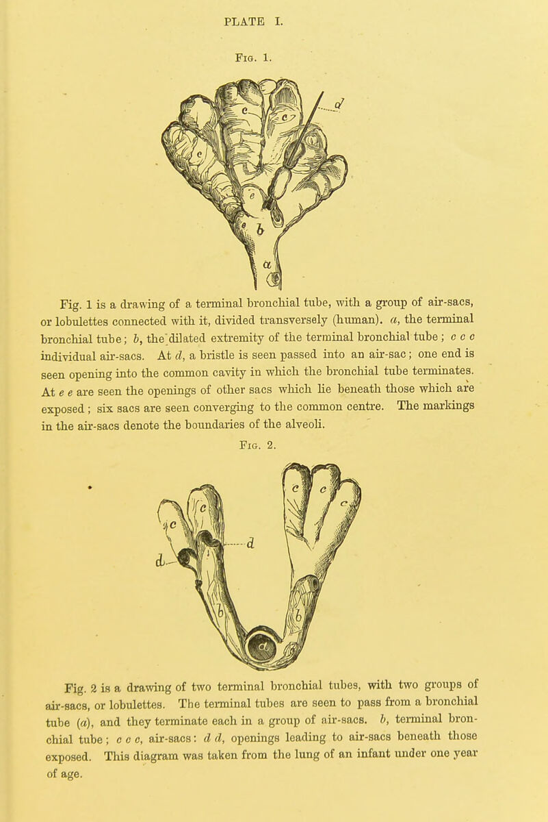 Fig. 1. Fig. 1 is a drawing of a terminal bronchial tube, with a group of air-sacs, or lobulettes connected with it, divided transversely (human), a, the terminal bronchial tube; b, the'dilated extremity of the terminal bronchial tube ; c c c individual air-sacs. At d, a bristle is seen passed into an air-sac; one end is seen opening into the common cavity in which the bronchial tube terminates. At e e are seen the openings of other sacs which he beneath those wbich are exposed ; six sacs are seen converging to the common centre. The markings in the air-sacs denote the boundaries of the alveoli. Fig. 2. Fig. 2 is a drawing of two terminal bronchial tubes, with two groups of air-sacs, or lobulettes. The terminal tubes are seen to pass from a bronchial tube (a), and they terminate each in a group of air-sacs, b, terminal bron- chial tube; ccc, air-sacs: d d, openings leading to air-sacs beneath those exposed. This diagram was taken from the lung of an infant under one year of age.