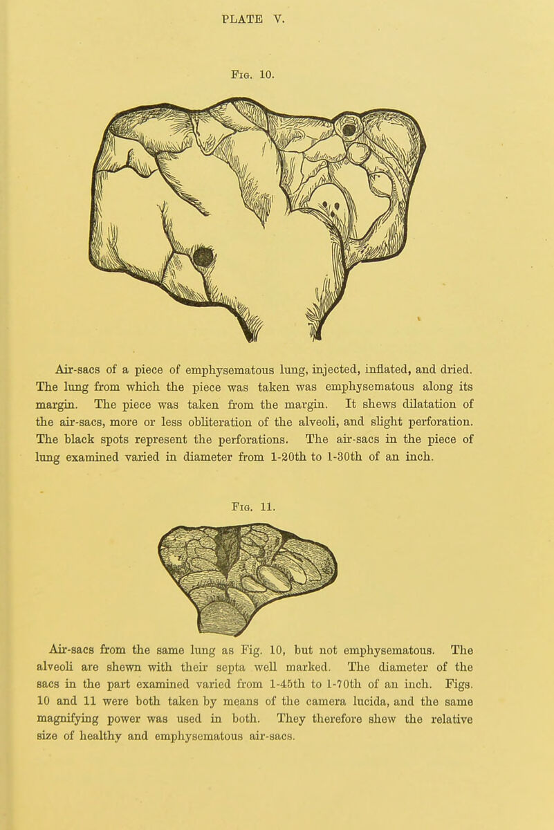 Fig. 10. Air-sacs of a piece of emphysematous lung, injected, inflated, and dried. The lung from which the piece was taken was emphysematous along its margin. The piece was taken from the margin. It shews dilatation of the air-sacs, more or less obliteration of the alveoli, and slight perforation. The black spots represent the perforations. The air-sacs in the piece of lung examined varied in diameter from l-20th to l-30th of an inch. Fig. 11. Air-sacs from the same lung as Fig. 10, but not emphysematous. The alveoli are shewn with their septa well marked. The diameter of the sacs in the part examined varied from l-45th to 1-70th of an inch. Figs. 10 and 11 were both taken by means of the camera lucida, and the same magnifying power was used in both. They therefore shew the relative size of healthy and emphysematous air-sacs.
