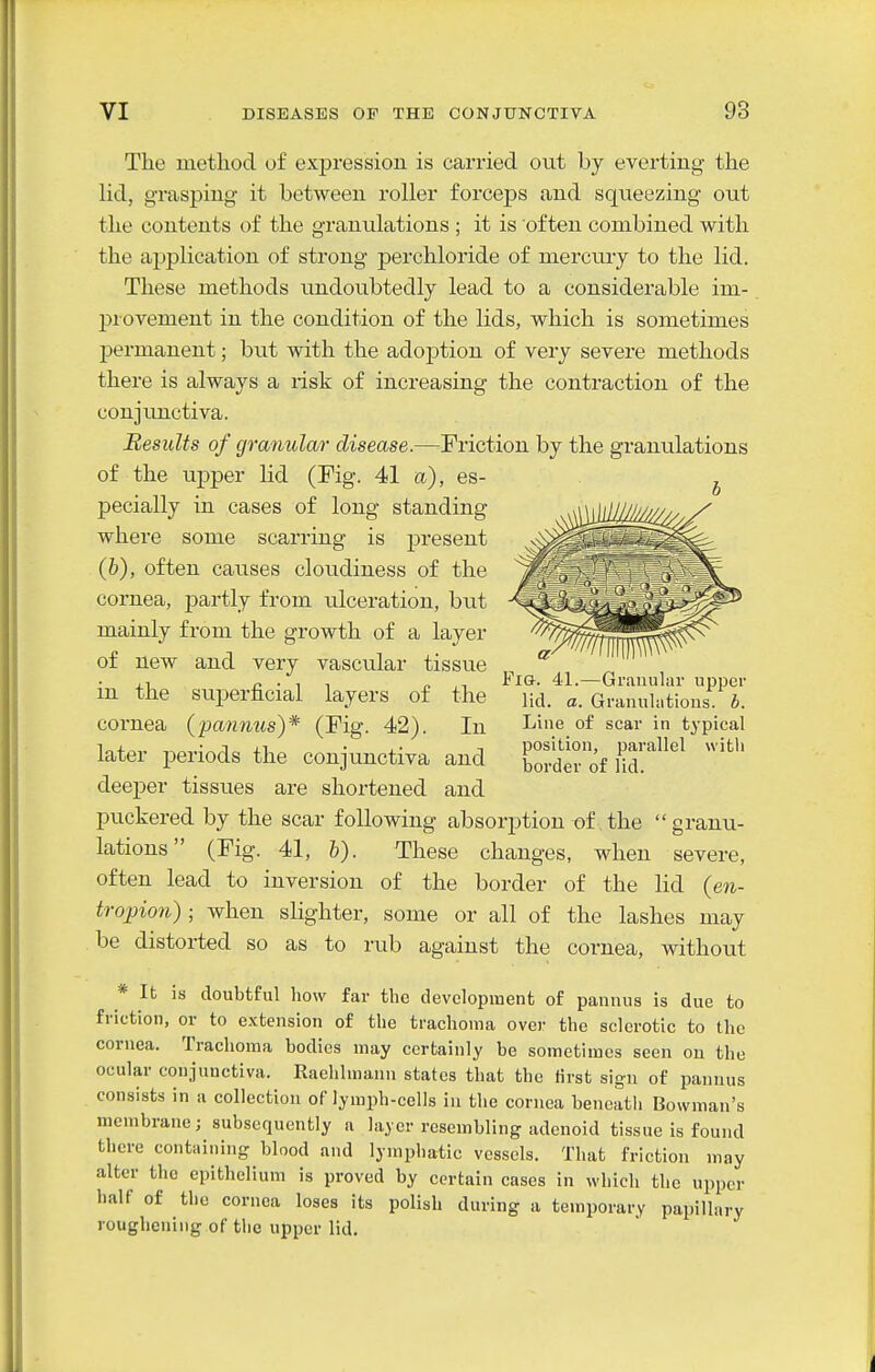The method of expression is carried out by everting the lid, grasping it between roller forceps .and squeezing out the contents of the granulations ; it is often combined with the ajiplication of strong perchloride of mercury to the lid. These methods undoubtedly lead to a considerable im-. provement in the condition of the lids, which is sometimes permanent; but with the adoj)tion of very severe methods there is always a risk of increasing the contraction of the conjunctiva. Results of granular disease.—rriction by the granulations of the upper lid (Fig. 41 a), es- pecially in cases of long standing where some scarring is present (6), often causes cloitdiness of the cornea, partly from ulceration, but mainly from the growth of a layer of new and very vasctdar tissue ,1 n • ^ ^ o 41.—Grauular upper m the superficial layers of the nd. a. Granuh.tious 5. cornea {pannus)* (Fig. 42) In ^^^q of scar in typical later periods the conjunctiva and Tordt'of Hd!''* deeper tissues are shortened and puckered by the scar following absorption of the granu- lations (Fig. 41, h). These changes, when severe, often lead to inversion of the border of the lid {en- tropion) ; when slighter, some or all of the lashes may be distorted so as to rub against the cornea, without * It is doubtful how far the development of pannus is due to friction, or to extension of the trachoma over the sclerotic to the cornea. Trachoma bodies may certainly be sometimes seen ou the ocular conjunctiva. Raehhnaun states that the first sign of pannus consists in a collection of lymph-cells in the cornea beneath Bowman's membrane; subsequently a layer resembling adenoid tissue is found there containing blood and lymphatic vessels. That friction may alter the epithelium is proved by certain cases in which the upper half of the cornea loses its polish during a temporary papillary roughening of the upper lid.