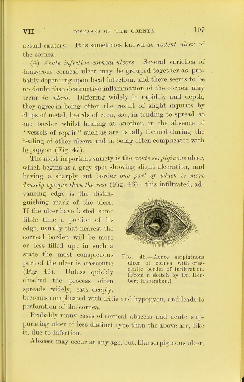 actucal cautery. It is sometimes known as rodent ulcer of the cornea. (4) Acide infective corneal ulcers. Several varieties of dangerous corneal ulcer may be grouped together as pro- bably depending upon local infection, and there seems to be no doubt that destructive inflammation of the cornea may occm- in utero. Differing widely in rapidity and depth, they agree in being often the result of slight injuries by chips of metal, beards of corn, &c., in tending to spread at one border wliilst healing at another, in the absence of  vessels of repair  such as are usually formed during the healing of other ulcers, and in being often complicated with hypopyon (Fig. 47). The most important variety is the acute serpiginous ulcer, which begins as a grey spot showing slight ulceration, and having a sharply cut border one part of which is more densely opaque than the rest (Fig. 46) ; this infiltrated, ad- vancing edge is the distin- guishing mark of the ulcer. If the ulcer have lasted some little time a portion of its edge, usually that nearest the corneal border, will be more or less filled up; in such a state the most conspicuous part of the ulcer is crescentic (Fig. 46). Unless quickly checked the process often spreads widely, eats deeply, becomes complicated with iritis and hypopyon, and leads to perforation of the cornea. Probably many cases of corneal abscess and acute sup- purating ulcer of less distinct type than the above are, like it, due to infection. Abscess may occur at any age, but, like serpiginous ulcer, Fig. 46.— Acute serpiginous ulcer of cornea with cres- centic border of infiltration. (Prom a sketch by Dr. Her- bert Habershon.)