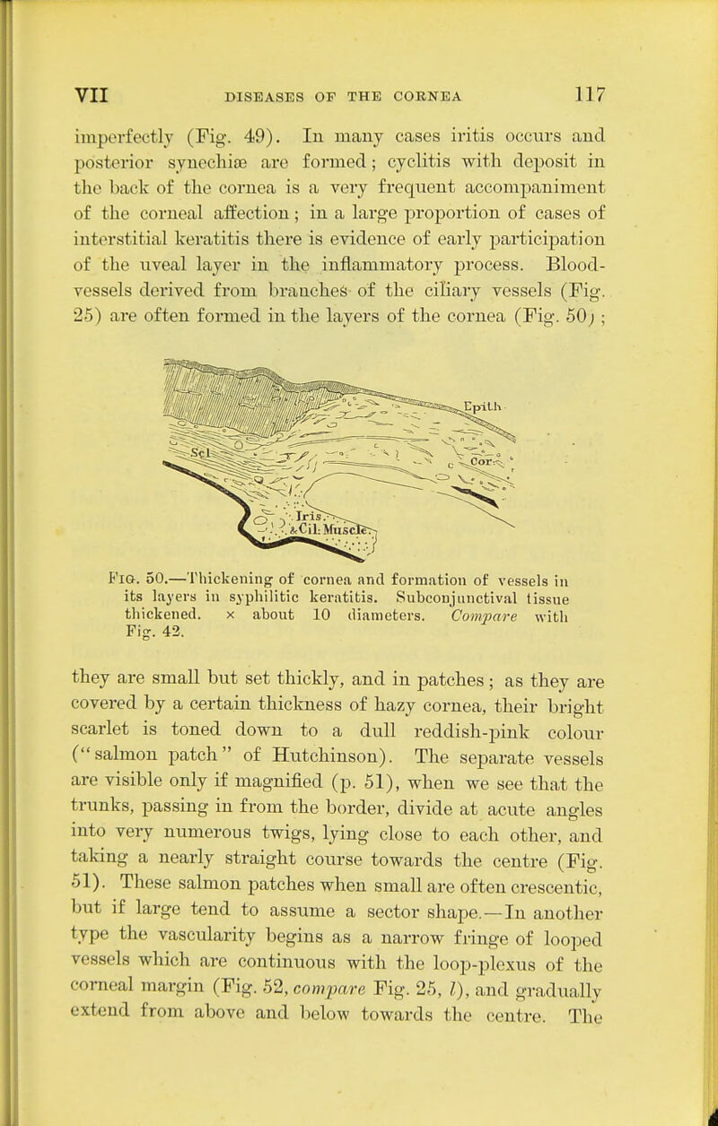imperfectly (Fig. 49). In many cases iritis occurs and posterior synechise are formed; cyclitis with deposit in the baclf of the cornea is a very frequent accompaniment of the corneal affection; in a large proportion of cases of interstitial keratitis there is evidence of early participation of the uveal layer in the inflammatory process. Blood- vessels derived from branches of the ciliary vessels (Fig. 25) are often formed in the layers of the cornea (Fig. 50;; Fig. 50.—Tlnckening of cornea and formation of vessels in its layers in syphilitic keratitis. Subconjunctival tissue thickened. x about 10 diameters. Compare with Fig. 42. they are small but set thickly, and in patches; as they are covered by a certain thickness of hazy cornea, their bright scarlet is toned down to a dull reddish-pink colour (salmon patch of Hutchinson). The separate vessels are visible only if magnified (p. 51), when we see that the trunks, passing in from the border, divide at acute angles into very numerous twigs, lying close to each other, and taking a nearly straight course towards the centre (Fig. 51). These salmon patches when small are often crescentic, but if large tend to assume a sector shape.—In another type the vascularity begins as a narrow fringe of looped vessels which are continuous with the loop-plexus of the corneal margin (Fig. 52, compare Fig. 25, I), and gradually extend from above and below towards the centre. The
