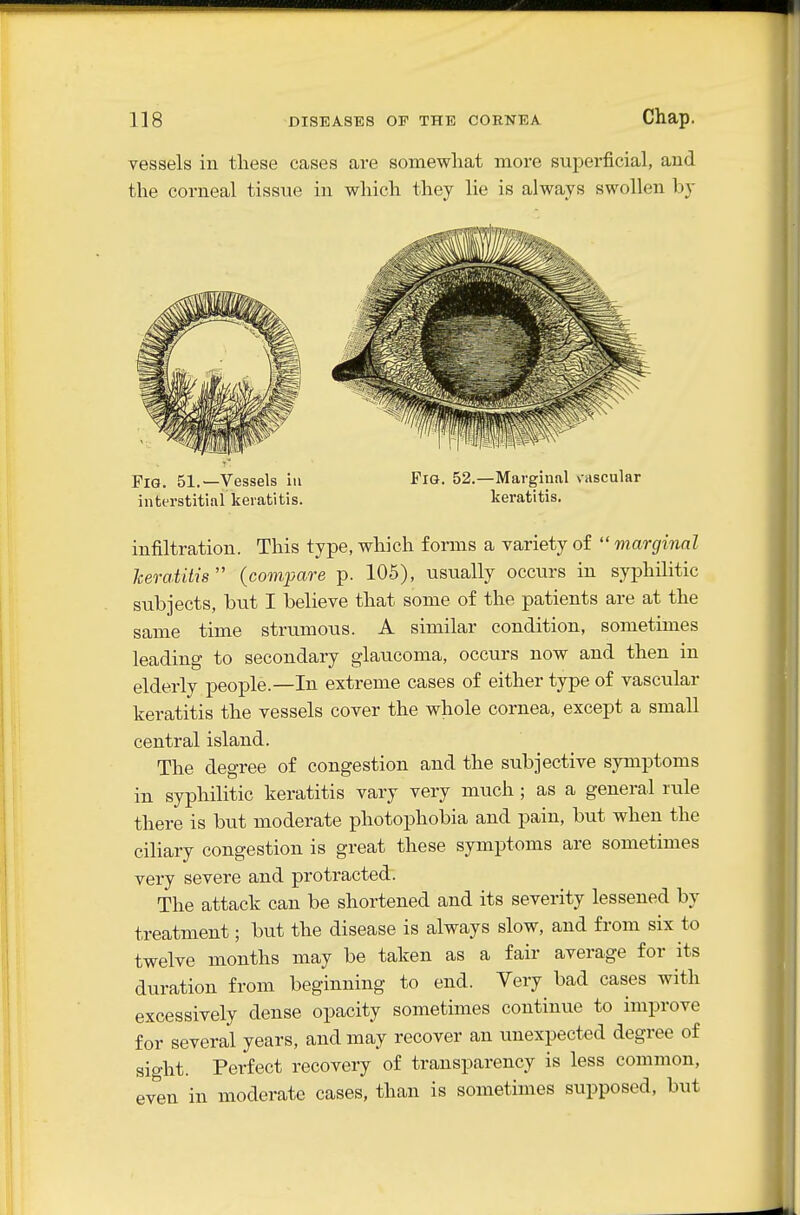vessels in these cases ave somewhat more superficial, and the corneal tissue in which they lie is always swollen by infiltration. This type, which forms a variety of  marginal heratilis  {compare p. 105), usually occurs in syphilitic subjects, but I believe that some of the patients are at the same time strumous. A similar condition, sometimes leading to secondary glaucoma, occurs now and then in elderly people.—In extreme cases of either type of vascular keratitis the vessels cover the whole cornea, except a small central island. The degree of congestion and the subjective symptoms in syphilitic keratitis vary very much ; as a general rule there is but moderate photophobia and pain, but when the ciliary congestion is great these symptoms are sometimes very severe and protracted. The attack can be shortened and its severity lessened by treatment; but the disease is always slow, and from six to twelve months may be taken as a fair average for its duration from beginning to end. Very bad cases with excessively dense opacity sometimes continue to improve for several years, and may recover an unexpected degree of sight. Perfect recovery of transparency is less common, even in moderate cases, than is sometimes supposed, but Fig. 51.—Vessels in interstitial keratitis. Fig. 52.—Marginal vascular keratitis.