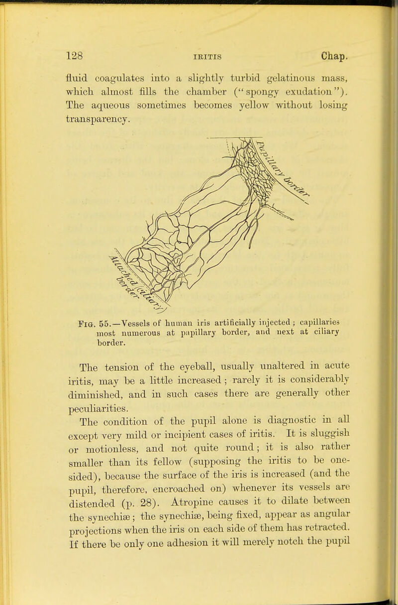 fiiiid coagulates into a slightly turbid gelatinous mass, which almost fills the chamber (spongy exudation). The aqueous sometimes becomes yellow without losing transparency. Fig. 55.—Vessels of human iris artificially injected ; capillaries most numerous at papillary border, and next at ciliary border. The tension of the eyeball, usually unaltered in acute iritis, may be a little increased; rarely it is considerably diminished, and in such cases there are generally other peculiarities. The condition of the pupil alone is diagnostic in all except very mild or incipient cases of iritis. It is sluggish or motionless, and not quite round; it is also rather smaller than its fellow (supposing the iritis to be one- sided), because the surface of the iris is increased (and the pupil, therefore, encroached on) whenever its vessels are distended (p. 28). Atropine causes it to dilate between the synechiee; the synechia, being fixed, appear as angular projections when the iris on each side of them has retracted. If there be only one adhesion it will merely notch the pupil