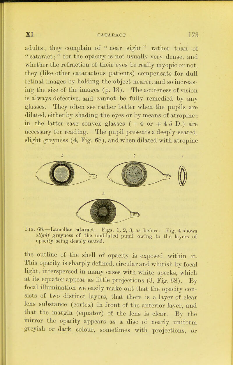 adults; they complain of  near sight  rather than of  cataract;  for the oj^acity is not usually very dense, and whether the refraction of their eyes be really myopic or not, they (like other cataractous patients) compensate for dull retinal images by holding the object nearer, and so increas- ing the size of the images (p. 18). The acuteness of vision is always defective, and cannot be fully remedied by any glasses. They often see rather better when the pupils are dilated, either by shading the eyes or by means of atropine ; in the latter case convex glasses (+4 or + 4'5 D.) are necessary for reading. The pupil presents a deei^ly-seated, slight greyness (4, Pig. 68), and when dilated with atropine Fig. 68.—Lamellar cataract. Figs. 1, 2, 3, as before. Fig. 4 shows sliffht greyness of the uudilated pupil owing to the layers of opacity being deeply seated. the outline of the shell of opacity is exposed within it. This opacity is sharply defined, circular and whitish by focal light, interspersed in many cases with white specks, which at its equator appear as little projections (8, Fig. 68). By focal illumination we easily make out that the opacity con- sists of two distinct layers, that there is a layer of clear lens substance (cortex) in front of the anterior layer, and that the margin (equator) of the lens is clear. By the mirror the opacity appears as a disc of nearly uniform greyish or dark colour, sometimes with projections, or