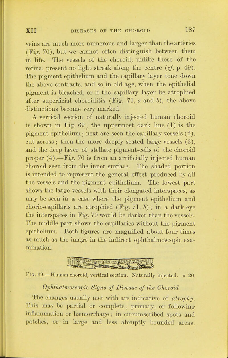veins are much more numerous and larger than the arteries (Fig. 70), hut we cannot often distinguish between them in life. The vessels of the choroid, unlike those of the retina, present no light streak along the centre (c/. p. 49). The pigment epithelium and the capillary layer tone down the above contrasts, and so in old age, when the epithelial pigment is bleached, or if the capillary layer be atrophied after superficial choroiditis (Fig. 71, a and h), the above distinctions become very marked. A vertical section of naturally injected human choroid is shown in Fig. 69; the uppermost dark line (1) is the pigment epithelium; next are seen the capillary vessels (2), cut across ; then the more deeply seated large vessels (3), and the deep layer of stellate pigment-cells of the choroid proper (4).—Fig. 70 is from an artificially injected human choroid seen from the inner surface. The shaded jDortion is intended to represent the general effect produced by all the vessels and the pigment epithelium. The lowest part shows the large vessels with their elongated interspaces, as may be seen in a case where the pigment epithelium and chorio-capillaris are atrophied (Fig. 71, h) ; in a dark eye the interspaces in Fig. 70 would be darker than the vessel<=!. The middle part shows the capillaries without the pigment epithelium. Both figures are magnified about four times as much as the image in the indirect ophthalmoscopic exa- mination. Fig. 69.—Human choroid, vex-tical section. Naturally injected, x 20. O'pMlialmoscopic Signs of Disease of the Choroid The changes usually met with are indicative of atrophy. This may be 2)artial or complete ; primary, or following inflammation or haemorrhage ; in circumscribed spots and patches, or in large and less abruptly bounded areas.