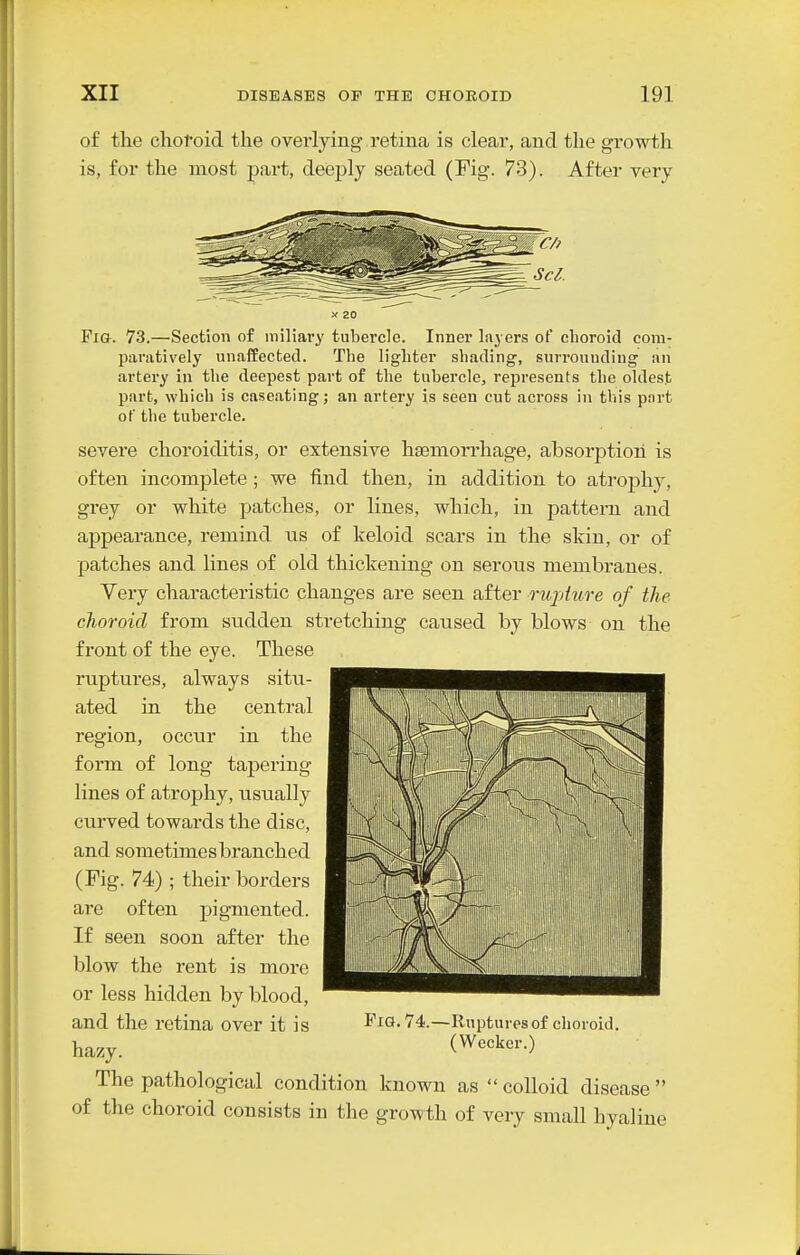 of the clioroid the overlying retina is clear, and the growth is, for the most part, deeply seated (Fig. 73). After very X 20 Fig. 73.—Section o£ miliary tubercle. Inner liiyers of choroid com- paratively unaffected. The lighter shading, surrounding an artery in the deepest part of the tubercle, represents the oldest part, which is caseating; an artery is seen cut across in tliis pnrt of the tubercle. severe choroiditis, or extensive hajmorrhage, absorption is often incomplete ; we find then, in addition to atrophy, grey or white patches, or lines, which, in pattern and appearance, remind ns of keloid scars in the skin, or of patches and lines of old thickening on serous membranes. Very characteristic changes are seen after ruphcre of the choroid from sudden stretching caused by blows on the front of the eye. These ruptures, always situ- ated in the central region, occur in the form of long tapering lines of atrophy, usually curved towards the disc, and sometimes branched (Fig. 74) ; their borders are often pigmented. If seen soon after the blow the rent is more or less hidden by blood, and the retina over it is hazy. The pathological condition known as  colloid disease  of the choroid consists in the growth of very small hyaline