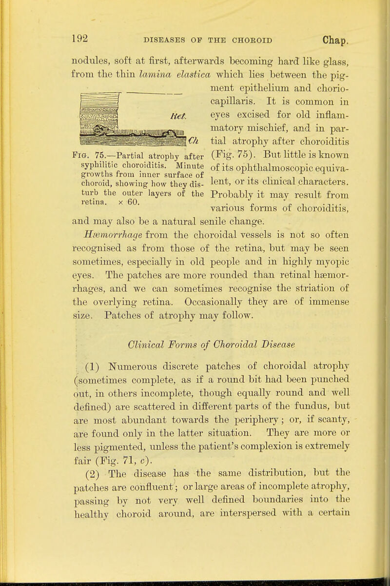 nodules, soft at first, afterwards becoming hard like glass, from the thin lamina elastica which lies between the pig- _ ment epithelium and chorio- capillaris. It is common in eyes excised for old inflam- matory mischief, and in par- tial atrophy after choroiditis Pig. 75.—Partial atrophy after (I^ig-75). But little is known syphilitic choroiditis. Minute of its ophthalmoscopic equiva- growths from inuer surface of , , ., . . , ^ choroid, showing how they dis- ^^nt, or its clinical characters, turb the outer layers of the Probably it may result from retina, x 60. ■ e £ • tx- various forms ot choroiditis, and may also be a natural senile change. Hiemorrhage from the choroidal vessels is not so often recognised as from those of the retina, but may be seen sometimes, especially in old people and in highly myopic eyes. The patches are more rounded than retinal haemor- rhages, and we can sometimes recognise the striation of the overlying retina. Occasionally they are of immense size. Patches of atrophy may follow. Clinical Forms of Choroidal Disease (1) Numerous discrete patches of choroidal atrophy (^sometimes complete, as if a round bit had been punched out, in others incomplete, though equally round and well defined) are scattered in different parts of the fundus, but are most abundant towards the periphery; or, if scanty, are found only in the latter situation. They are more or less pigmented, unless the patient's complexion is extremely fair (Fig. 71, c). (2) The disease has the same distribution, but the patches are confluent; or large areas of incomplete atrophy, passing by not very well defined boundaries into the healthy choroid around, are interspersed with a certain