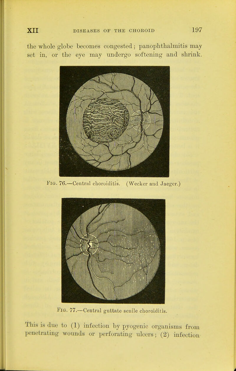 the whole globe becomes congested _; panophthalmitis may set in, or the eye may undergo softening and shrink. FiQ-. 76.—Central choroiditis. (Weckcr and Jaeger.) Fio. 77.—Central guttatc senile choroiditis. This is due to (1) infection by pyogenic organisms from penetrating wounds or perforating ulcers; (2) infection