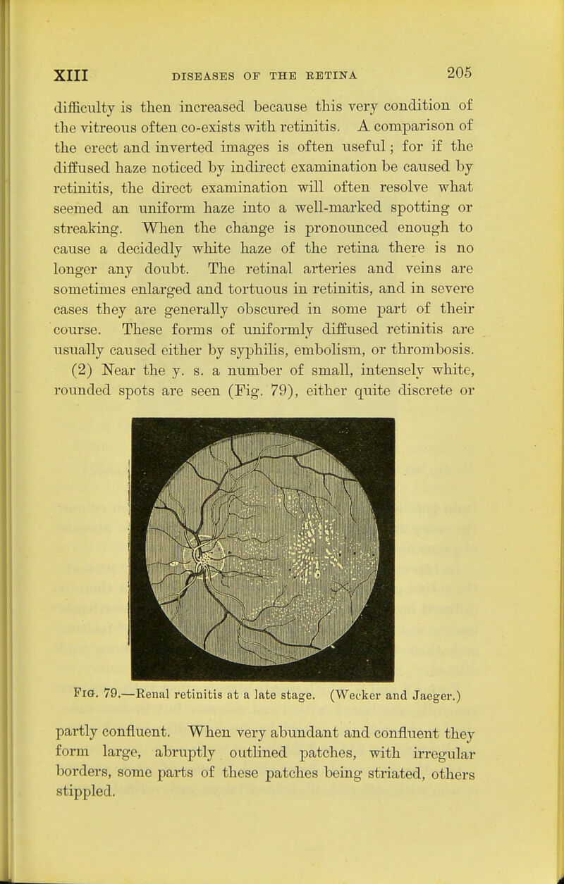 difficulty is then increased because this very condition of the vitreous often co-exists with retinitis. A comparison of the erect and inverted images is often useful; for if the diffused haze noticed by indirect examination be caused by retinitis, the direct examination will often resolve what seemed an uniform haze into a well-marked spotting or streaking. Wlien the change is pronounced enough to cause a decidedly white haze of the retina there is no longer any doubt. The retinal arteries and veins are sometimes enlarged and tortuous in retinitis, and in severe cases they are generally obscured in some part of their course. These forms of uniformly diffused retinitis are usually caused either by syphilis, embolism, or thrombosis. (2) Near the y. s. a number of small, intensely white, rounded spots are seen (Fig. 79), either quite discrete or Fig. 79.—Renal retinitis at a late stage. (Wecker and Jaeger.) partly confluent. When very abundant and confluent they form large, abruptly outlined patches, with irregular borders, some parts of these patches being striated, others stippled.