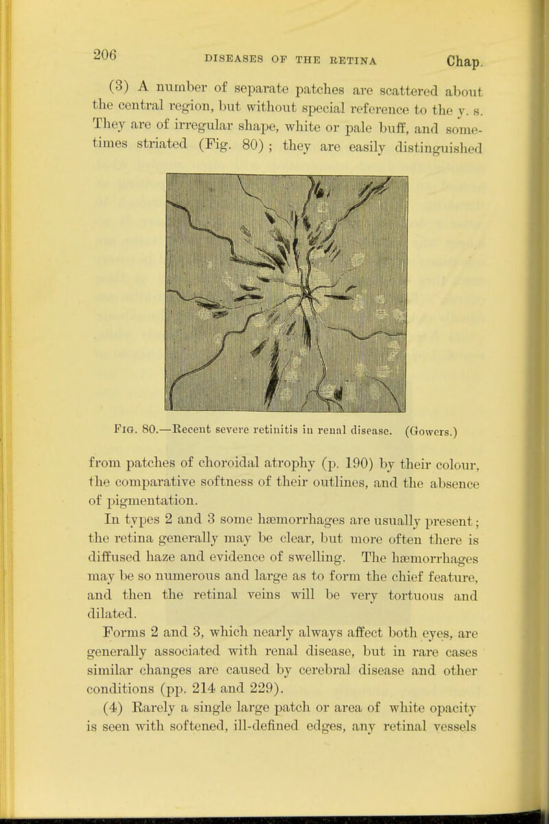 (3) A number of separate patches are scattered alDont the central region, but without special reference to the y. s. They are of irregular shape, white or pale bufp, and some- times striated (Fig. 80) ; they are easily distinguished Fia. 80.—Recent severe retinitis in renal disease. (Gowers.) from patches of choroidal atrophy (p. 190) by their colour, the comparative softness of their outlines, and the absence of pigmentation. In types 2 and 3 some haemorrhages are usually present; the retina generally may be clear, but more often there is diffused haze and evidence of swellinsr. The haemorrhao-es may be so numerous and large as to form the chief feature, and then the retinal veins vs^ill be very tortuous and dilated. Forms 2 and 3, which nearly always affect both eyes, are generally associa.ted with renal disease, but in rare cases similar changes are caused by cerebral disease and other conditions (pp. 214 and 229). (4) Rarely a single large patch or area of white opacity is seen with softened, ill-defined edges, any retinal vessels