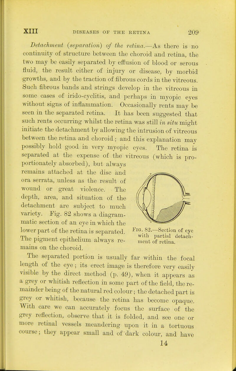 Detachment {separation) of the retina.—As there is no contiuuity of structure between tlie choroid and retina, the two may be easily separated by effusion of blood or serous fluid, the result either of injury or disease, by morbid growths, and by the traction of fibrous cords in the vitreous. Such fibrous bands and strings develop in the vitreous in some cases of irido-cyclitis, and perhaps in myopic eyes without signs of inflammation. Occasionally rents may be seen in the separated retina. It has been suggested that such rents occurring whilst the retina was still in situ might initiate the detachment by allowing the intrusion of vitreous between the retina and choroid ; and this explanation may possibly hold good in very myopic eyes. The retina is separated at the expense of the vitreous (which is pro- portionately absorbed), but always remains attached at the disc and ora serrata, unless as the result of wound or great violence. The depth, area, and situation of the detachment are subject to much variety. Fig. 82 shows a diagram- matic section of an eye in which the lower part of the retina is separated. The pigment epithelium always re- mains on the choroid. The separated portion is usually far within the focal length of the eye; its erect image is therefore very easily visible by the direct method (p. 49), when it appears as a grey or whitish reflection in some part of the field, the re- mainder being of the natural red colour; the detached part is grey or whitish, because the retina has become opaque. With care we can accurately focus the surface of the grey reflection, observe that it is folded, and see one or more retinal vessels meandering upon it in a tortuous course; they appear small and of dark coloui-, and have 14 EiG. 82.—Section of eye with partial detacli- ment of retina.