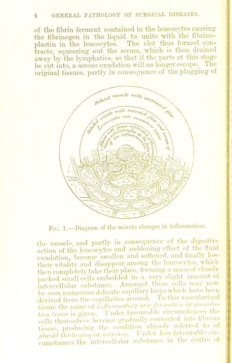 of the fibrin ferment contained in the leucocytes causing the fibrinogen in the liquid to unite with the fibrino- plastin in the leucocytes. The clot thus fonned con- tracts, squeezing out the serum, -w-hich is then drained away by the lymphatics, so that if the parts at this stage be cut into, a serous exudation will no longer escape.^ The original tissues, partly in consequence of the plugging of the vessels, and partly in consequence of the digcstm- action of the leucocytes and soddcnuig effect of the iluid exudation, bocmne swollen and softened, and finally lose their vitality and disiqipear among the leucocytes, which then complc'tely take Ihrir ])lace, forming n mass of closeh' iiacked small colls emlieddcd in a very slight amount oi intercellular substniicc Amongst these cells mi.y now lu> seminiimevousdclicide capillary ]oo].s which have been derived fr<«ni ihe rai>illaiii's ainiiiul. To this vascularized tissue the name of i»/hniinniiorii unr f,.vm<i1 u.i, or;jraini/,i- //„» li.^su,' is i,nven. ' Tiider favourable circumstances fh.> cells themselves become rrra.bially converted into fibrous tissue, producim; the cenditien already referred to _o1 /ihroul ihlrhrinmi or »r„rviu,i. Tiuh'T less iavourable cir- cuni'itances the intercellular substance in the centre oi