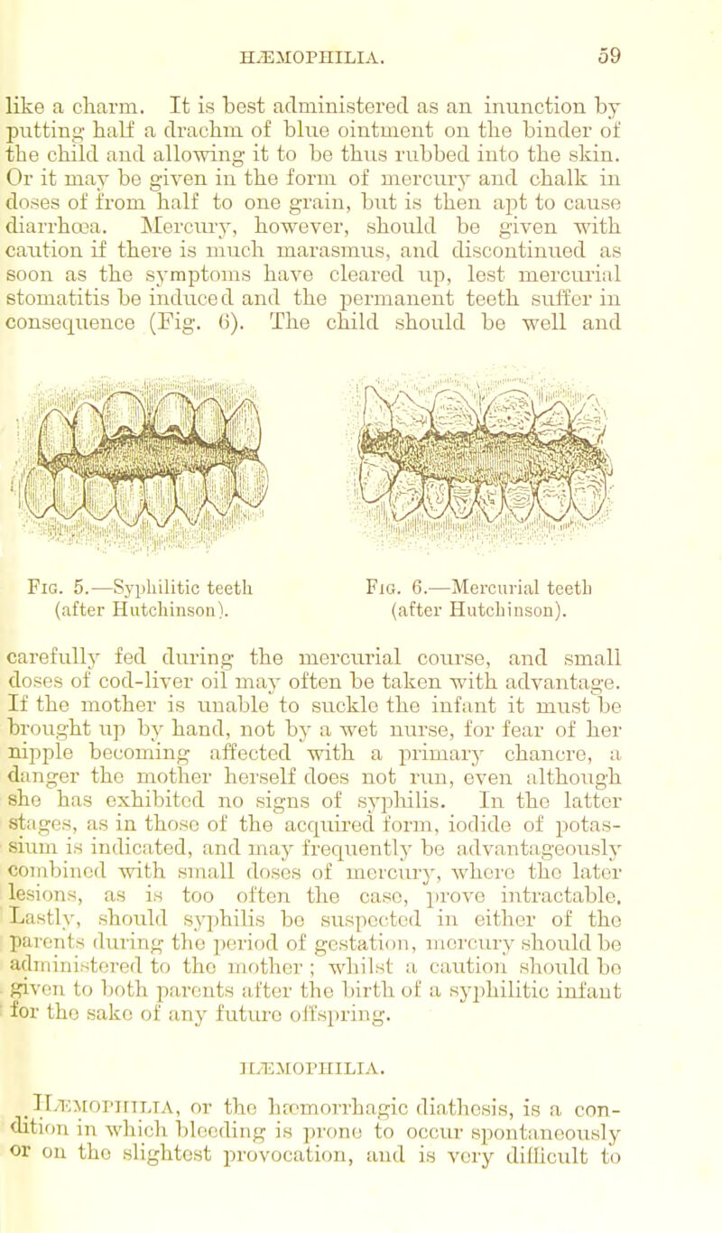 like a cliarm. It is best aclministerecl as an inimction by putting half a draclim of blue ointment on the binder of the child and allomng it to be thvis rubbed into the skin. Or it may be given in the form of mercury and chalk in doses of from half to one grain, but is then apt to cause diarrhcca. Mercm-y, however, should be given with caution if there is much marasmus, and discontinued as soon as the symptoms have cleared up, lest mercimal stomatitis be induce d and the permanent teeth suffer in consequence (Fig. 6). The child should be well and Fig. 5.—Syphilitic teetli Fig. 6.—Mercurial teetL (after Hutchinson). (after Hutchinson). carefully fed during the mercurial course, and small doses of cod-liver oil may often be taken with advantage. If the mother is unable to suckle the infant it must be brought up by hand, not by a wet nurse, for fear of her nipple becoming affected with a j)rimary chancre, a danger the mother herself does not run, even although she has exhibited no signs of syphilis. In the latter stages, as in those of the acquired form, iodide of potas- sium is indicated, and may frequently be advantageously combined with small doses of mercury, whci'o the later lesions, as is too often the case, prove intractable. ' Lastly, should syphilis be suspected in either of the parents during the period of gestation, mercury should be administered to the mother ; whilst a caution should bo given to both parents after the bu-th of a syphilitic infant ■ for the sake of any futui'o oifspring. ILEJIOPHILIA. TLio^rorinTJA, or the hrcmorrhagic diathesis, is a con- dition in which blooding is prone to occur spontaneously or ou the slightest provocation, and is very diflicult to