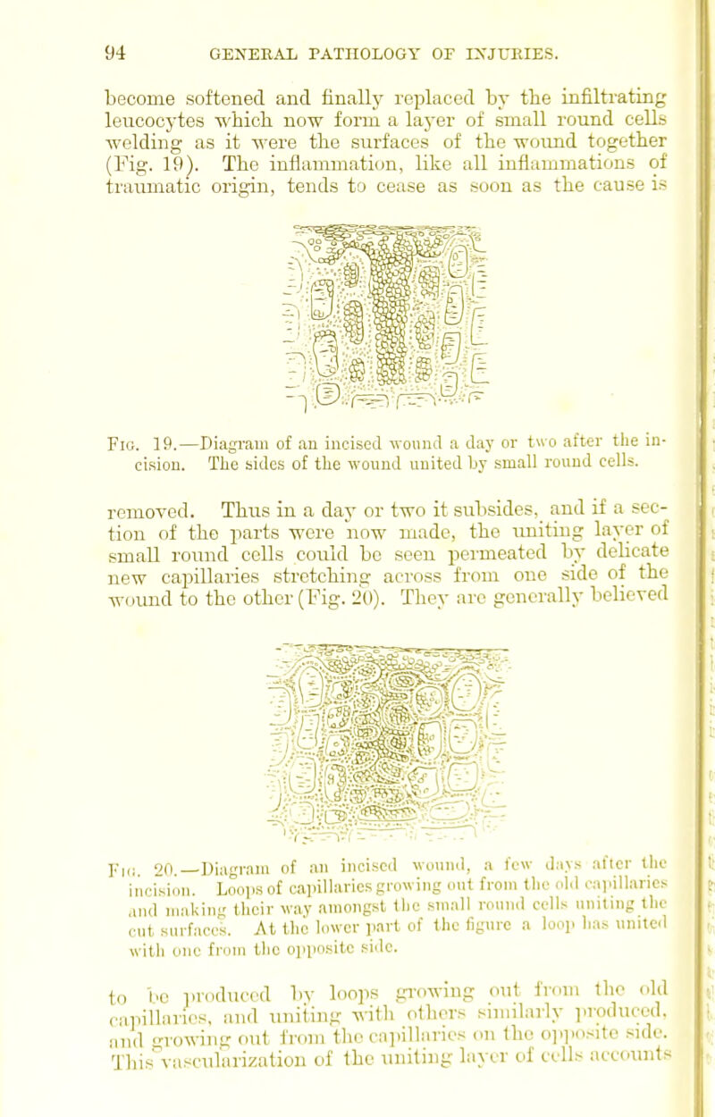 become softened and finalh' replaced by the infiltrating leucocytes which, now form a laj'er of small round cells welding as it were the surfaces of the woimd together (Fig. 19^. The inflammation, like all inflammations of traumatic origin, tends ta cease as soon as the cause is Fig. 19.—Diagram of an incised wonnd a daj' or tw o after the in- cision. The sides of the wound united by small round cells. removed. Thus in a day or two it subsides, and if a sec- tion of the parts were iiow made, the uniting layer of small round cells could be seen permeated by delicate new cajjillaries stretching across from one side of the wound to the other (Fig. 20). They are generally believed Fi(i. 20.—Diagram of an incised wound, a few days after the incision. Loops of ca]>illaries growing out from the old capillaries and making their way amongst the small round cells uniting the cut surfaces. At the lower part of the figure a loop has unite<l witii one from the ojiposite side. to be iiroduccd bv loops gi'owing out from the old capillaries, and tmiiing Avith others similarly ]iroduced, and growing out from the cajiillarics on the o].])o.-:ite .^idc. This%-ascularization of the uniting layer of cells accoinits