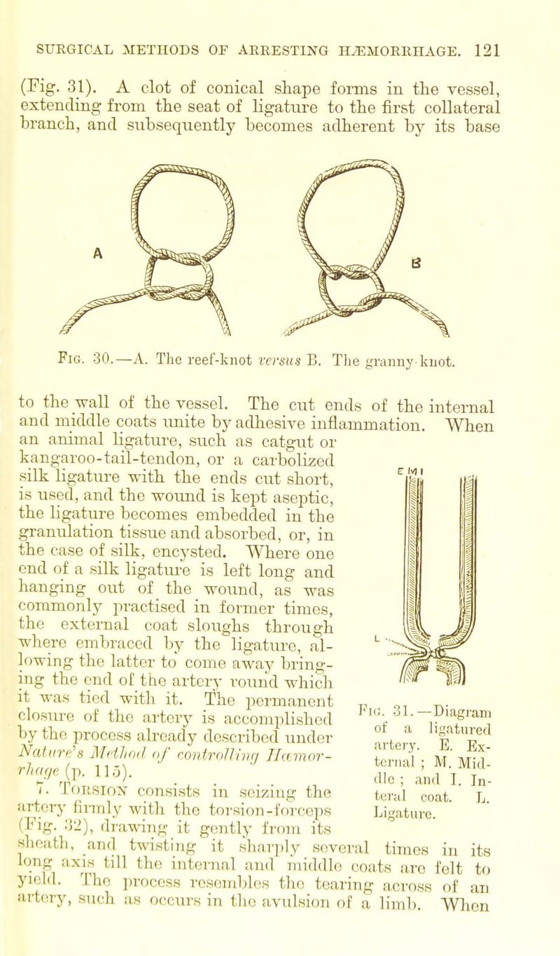 (Fig. 31). A clot of conical shape forms in the vessel, extending from the seat of ligature to the first collateral branch, and subsequently becomes adherent by its base Fig. 30.—a. The reef-knot tfcsif.s B. The granny kiiot. to the wall of the vessel. The cut ends of the internal and middle coats imite by adhesive inflammation. When an animal ligature, such as catgut or kangaroo-tail-tendon, or a carbolized silk ligatm-e with the ends cut short, is used, and the woimd is kept aseptic, the ligature becomes embedded in the granirlation tissue and absorbed, or, in the case of silk, encysted. Where one end of a silk ligatm-e is left long and hanging out of the wound, as was commonly practised in former times, the external coat sloughs through where embraced by the ligatiu'c, al- lowing the latter to come away bring- ing the end of the artery round which it was tied with it. The jici'manent closure of the artery is accomplished by the process already described under Nature's Mcthoil of coniroUimj Ilamor- rharje (p. 115). T. ToiisioN consists in seizing the arterj' hi-mly with the torsion-iVirceps (Fig. :32), drawing it gently from its shoath, and twisting it .sharply several times in long axis till the internal and middle coats are felt yield. The process rcsoinblos the tearing across of cixj iu-tery, such as occurs in tlio avulsion of a limb. VVlaon Fill. 31.- of a artery, ternal die ; and I. teral coat. Lirrature. Diagram ligatured E. Ex- M. Mid- In- L. its to an