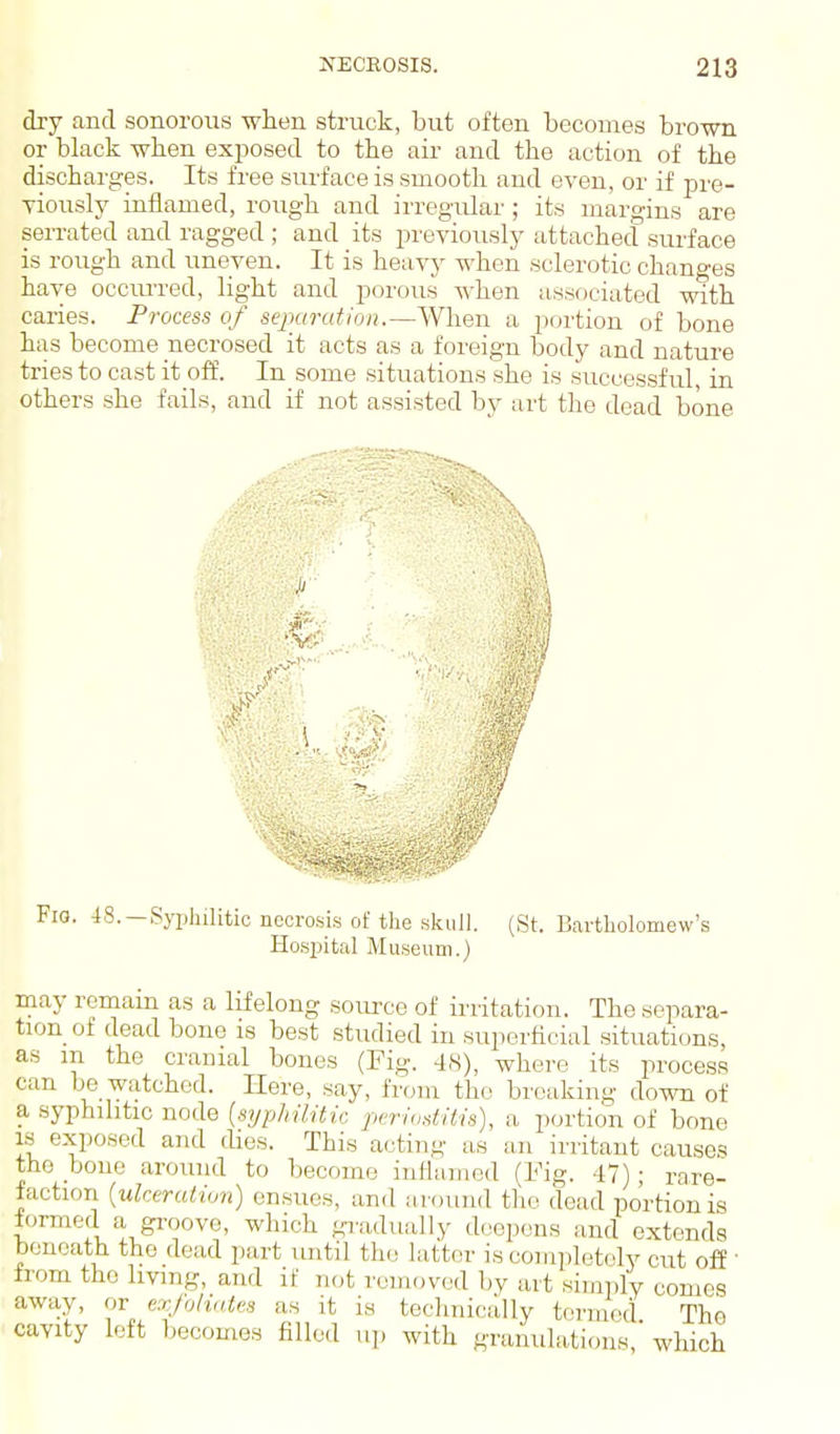 dry and sonorous -when struck, but often becomes brown or black when exposed to tbe air and the action of the discharges. Its free surface is smooth and even, or if pre- vioiisly inflamed, rough and irreguhii'; its margins are sen-ated and ragged ; and its previously attached surface is rough and uneven. It is heavj^ when sclerotic changes have occiu-red, light and porous when associated with caries. Process of separation.—When a jjortion of bone has become necrosed it acts as a foreign body and nature tries to cast it off. In some situations she is successful, in others she fails, and if not assisted by art the dead bone Fia. 48. —Syphilitic necrosis of the skull. (St. Bartholomew's Hosijital Museum.) may remain as a lifelong soiu-ce of irritation. The separa- tion of dead bono is best studied in superficial situations, as m the cranial bones (Fig. -IS), where its process can be watched. Here, say, from the breaking down of a syphilitic node [syphilUic periaditis), a portion of bone IS exposed and dies. This acting as an irritant causes the bone aroiuid to become infiamod (Fig. 47); rare- faction [ulceration) onsuos, and a round tlio dead portion is formed a gi'oovo, which gradually d(;epcns and extends beneath the dead part until the latter is completely cut off ' from the living, and if not removed bv art simidy comes away, or exjoliatcs as it is technically termed The cavity left becomes filled u]. with granulations, which