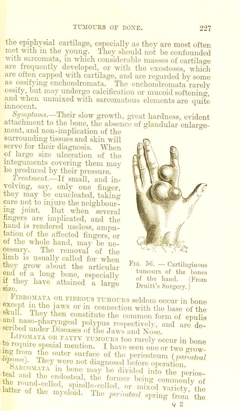 the epii^hysial cartihige, especially as thoy are most often met with m the young. They should not be confounded with sarcomata, in which considerable masses of cartilage are frequently developed, or with the exostoses, which are often cajDped -wdth cartilage, and are regarded by some as ossifying enchondromata. The enchondromata rarely ossify, but may undergo calcification or mucoid softening, and when unnuxed with sarcomatous elements are quite innocent. -S'^7/?^ji;o??is.—Their slow growth, great hardness, evident attachment to the bone, the absence of glandular enlarge- ment, and non-implication of the sui-rounding tissues and skin will serve for then- diagnosis. When of large size ulceration of the integiunents covering them may be produced by their pressure. Treatment.—If small, and in- volving, say, only one finger, they may be enucleated, taking care not to injiu'e the neighboiu'- ing joint. But when several fingers are implicated, and the hand is rendered useless, ampu- tation of the affected fingers, or of the whole hand, may be ne- cessary. The removal of the limb is usually called for when they grow about the articular end of a long bone, especially if they have attained a large size. P Jr?f'-''ti^'-' '^U-^^OURS seldom occur in bone sfn Tl +f^' ^?,^oii'iection with the base of the Skull. They then constitute the common form of epulis and naso-pharyngoal polypus respectively, and are de- scribed under Diseases of the Jaws and Nose. lAVimxri, OR FATTY TUMOURS too rarely occur in bono 0 require special mention. I have seen one or two grow- Z T S. •'^'•^^'^^ the periosteum {pa?osZl tpnl iu'^' '''-'y ^i^-i'lwl into the nerios y 2 Fia. 56. — Cartilaginous tumours of the bones of the hand. (From Druitt's Surgery.) the