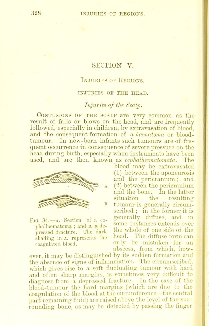 SECTION V. Injxtiiies op Eegioxs. injuries of the head. Injuries of the Scalp. Contusions of the scalp are very common as the result of falls or blows on the head, and are fi'equently followed, especially in childi-en, by exti-avasation of blood, and the consequent formation of a iKninatoma or blood- tumoui'. In new-born infants such tumours are of fre- quent occurrence in consequence of severe jiressui'e on the head during birth, especially when instruments have been used, and are then known as cephalhccimdumata. The blood may be extravasated (1) between the aponeurosis and the pericranium; and (2) between the pericrauiiun and the boue. In the latter situation the resultinsr tumour IS ijencrally circum- scribed ; in the former it is generally diffuse, and in some instances extends over the whole of one side of the head. The diffxise form can only be mistaken for an abscess, from wliicli, liow- ever, it may be distiiigviishod by its sudden formation and the absence of signs of iniianunation. The circumscribed, which gives rise to a soft fluctuating tumour witli hard and often sharp maigins, is sometimes very difficult to diagnose from a deiiressed fracture. In the case of the ])Iood-tuniour the hard margins (which arc (hic to the coagulation of the blood attlie circuiiiferencc—the central part remaining liuid) are raised above the level of the sur- rounding bono, as may be detected by passing the finger Fifl. 84.—A. Section of a ce- Ijlialli.'Btnatoma ; and u. a de- pressed fracture. Tlic dark shading in A. represents tlie coagulated blood.