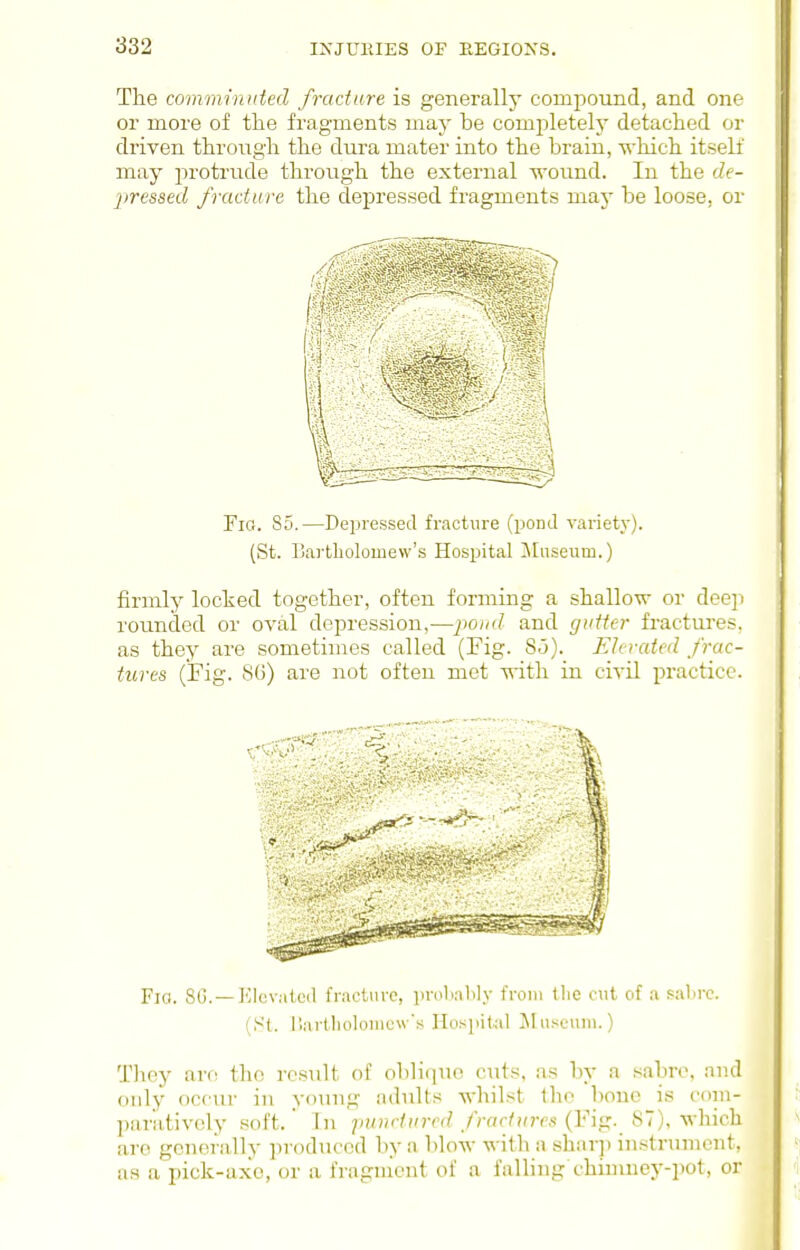 The comminuted fracture is generally compound, and one or more of the fragments may be completelj' detached or driven through the dura mater into the brain, Ts-hich itself may protrude through the external M-ound. In the de- jjressed fracture the depressed fi'agmeuts maj- be loose, or Yia. 85.—Depressed fracture (pond variety). (St. Bai-tliolouiew's Hospital Jliiseum.) firmly locked together, often forming a shallo-w or doeji rounded or oval depression,—pond and gutter fractures, as they are sometimes called (Fig. So). Elevated frac- tures (Fig. 8(3) are not often met -w-ith in civil practice. F:a. 80. —J'llevalcd fracture, ])niliably from tlie cut of a saljrc. (S'l. I'.artliolonicw's Ilosjiital Museum.) Tlioy are the result of obli(iuo ciits, as by a sabre, and only occur in young adults whilst the bouc is coni- paratively soft. In /iM^rffm? /Vrtf/((ms (Fig. 87), which are generally ]n-oduced l)y a blow with a shnrp instrument, as a pick-axe, or a fragnient of a falling chinmey-pot, or