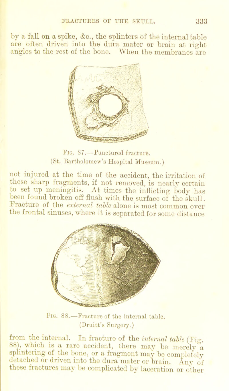 by a fall on a spike, &c., the splinters of the internal table are often driven into the dm-a mater or brain at right angles to the rest of the bone. When the membranes are Fig. 87.—Punctured fracture. (St. Bartholomew's Hospital Museuiii.) not injured at the time of the accident, the irritation of these sharp fragments, if not removed, is nearly certain to set up meningitis. At times the inflicting body has been found broken off flush with the surface of the skull. Fracture of the external tahle alone is most common over the frontal sinuses, where it is separated for some distance Fill. 88.—Fracture of tljc internal table. (Druitt's Surgery.) from the internal. In fracture of the ivtmiaJ tabJr (Fig. SS), which is a rare accndent, there may bo merely ^a sphntoring of the bone, or a fragment may be comidetoly detached or driven ijito the dura mater or brain. Any of these fractures may be complicated by laceration or other