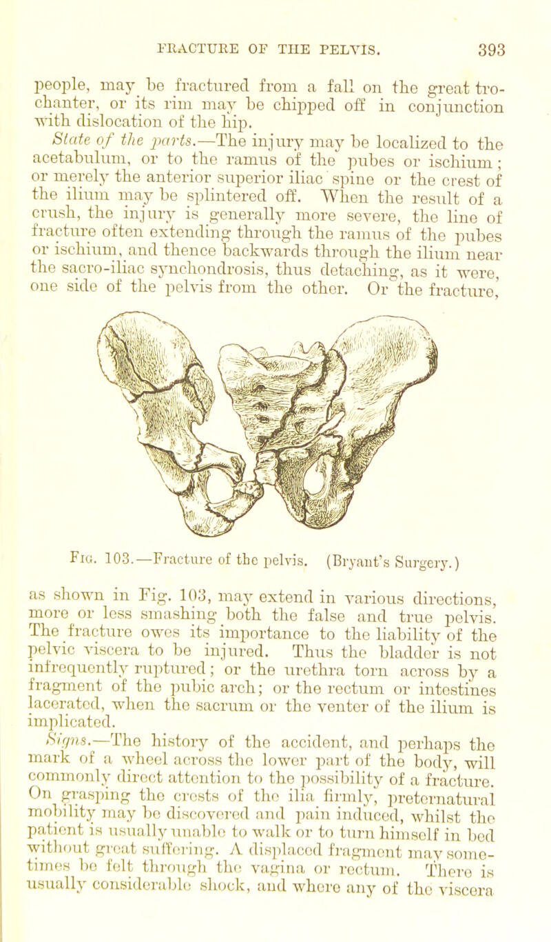 people, may be fractured from a fall on the great tro- chanter, or its rim may be chipped off in conjunction with dislocation of the liij). Slate of the ^mrts.—The injury may be localized to the acetabulum, or to the ramus of the pubes or ischium ; or merely the anterior superior iliac spine or the crest of the ilium may be splintered off. When the result of a crush, the injury is generally more severe, the line of fracture often extending throiigh the ramus of the pubes or ischium, and thence backwards through the ilium near the sacro-iliac synchondrosis, thus detaching, as it were, one side of the pelvis from the other. Or'the fracture,' Fio. 103.—Fracture of the pelvis. (Bryant's Surgery.) as .shown in Fig. 103, may extend in various directions, more or less sma.shing both the false and true pelvis. The fracture owes its importance to the liability of the pelvic viscera to be injured. Thus the bladder is not infrequently ruptured; or the urethra torn across by a fragment of the pubic arch; or the rectum or intestines lacerated, when the sacrum or the venter of the ilium is implicated. /S'/r/9;,8.—The history of the accident, and perhaps the niark of a Avheel across the lower part of the body, will commonly direct attention to the possibility of a fracture. On grasping the crests of the ilia firmly, preternatural moljility may bo discovered and pain induced, whilst the patient is usually unable to walk or to turn himself in lied without groat sulTtiring. A displaced fragment may some- times bo felt throuK'h thi^ va^'ina or rectmu. There is usually considerable .shock, and whore any of the viscera