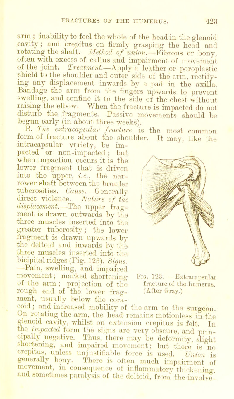 the most ■ It may, common like the arm ; inability to feel the whole of the head in the glenoid cavity; and crepitus on firmly grasping the head and rotating the shaft. IletJiod of union-—Fibrous or bony, often -with excess of callus and impairment of movement of the joint. Treatment.—K-^]Aj leather or poroplastic shield to the shoulder and outer side of the arm, rectify- ing any displacement inwards by a pad in the axilla. Bandage the arm from the fingers upwards to prevent swelling, and confine it to the side of the chest without raising the elbow. When the fracture is impacted do not disturb the fragments. Passive movements should be begun early (in about three weeks). B. The extracapsular fracture is form of fractm-e about the shouldei intracapsular variety, be im- pacted or non-impacted; but when impaction occurs it is the lower fragment that is driven into the upper, i.e., the nar- rower shaft between the broader tubero.sities. Cause.—Generally direct violence. Nature of the displacement.—The upper frag- ment is drawn outwards hj the thi-ee muscles inserted into the greater tuberosity; the lower fragment is drawn upwards by the deltoid and inwards by the three muscles inserted intij the bicipital ridges (Fig. 123). Signs. —Pain, swelling, and impaired movement; marked shortening of the arm; projection of the ment, usually below the cora- coid; and increased mobility of the arm to the surgeon. On rotating the arm, the head remains motionless in the glenoid cavity, whilst on extension crepitus is felt. In the ■i'lnqiaded form the signs are very obscure, and prin- cipally negative. Tluis, there may bo deformity, slight shortemng, and impaired movombnt; but there' is no crepitus, unless unjustifiiiblo force is used. Union is generally l)ony. There is r.fton much impairment o'r movement, m consiupieiice ol' inflammatory thickeniu' and sometimes paralysis of tlie deltoid, from the involve- Fic. \io. —Extracapsiil.ar fracture of the Juimenis.